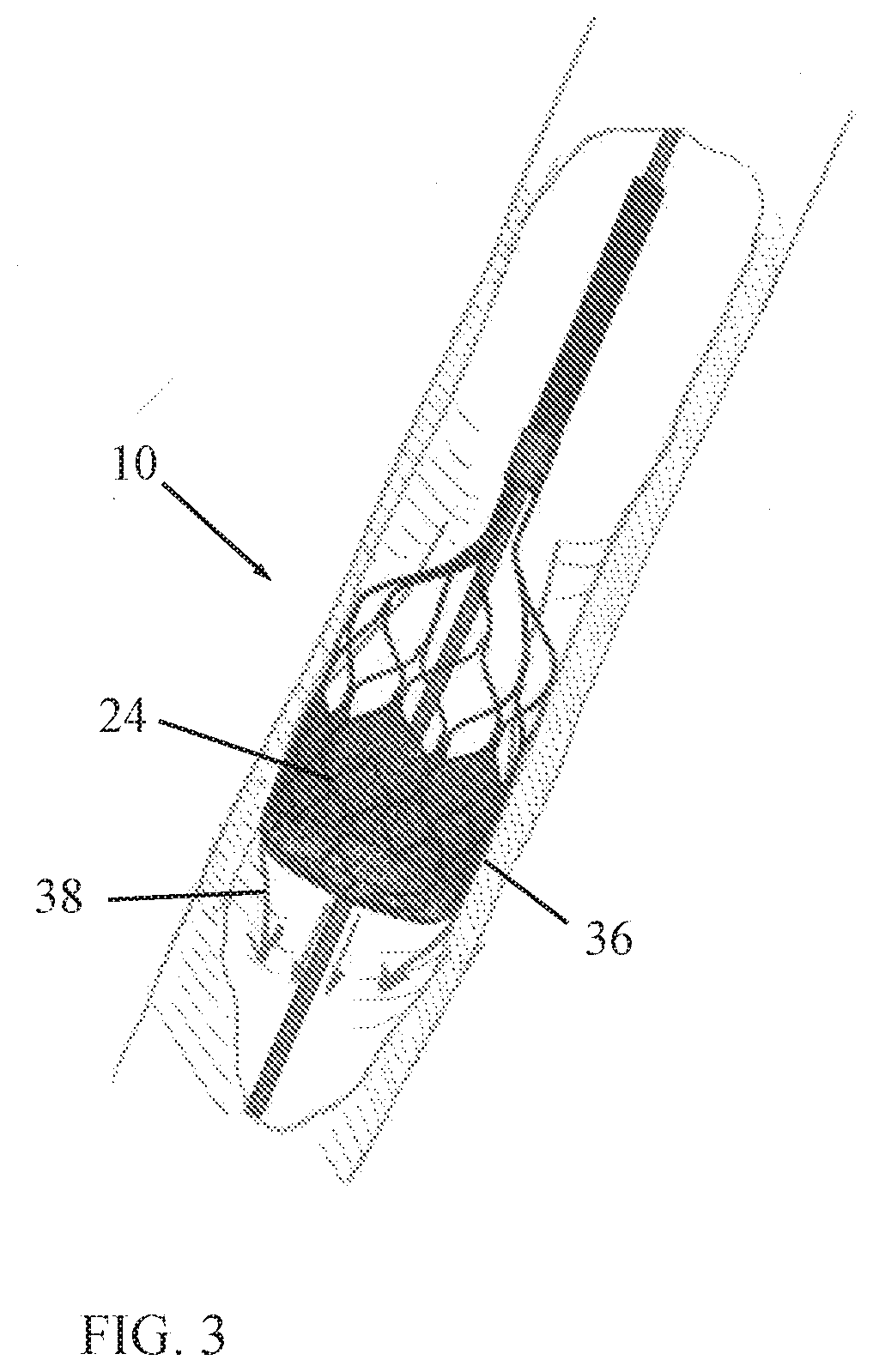 Flow occlusion device having circumferential flushing