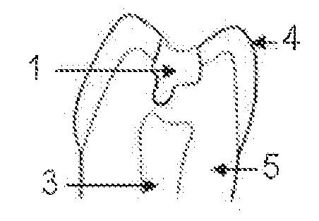 Mineral trioxide aggregate (MTA) composition and use