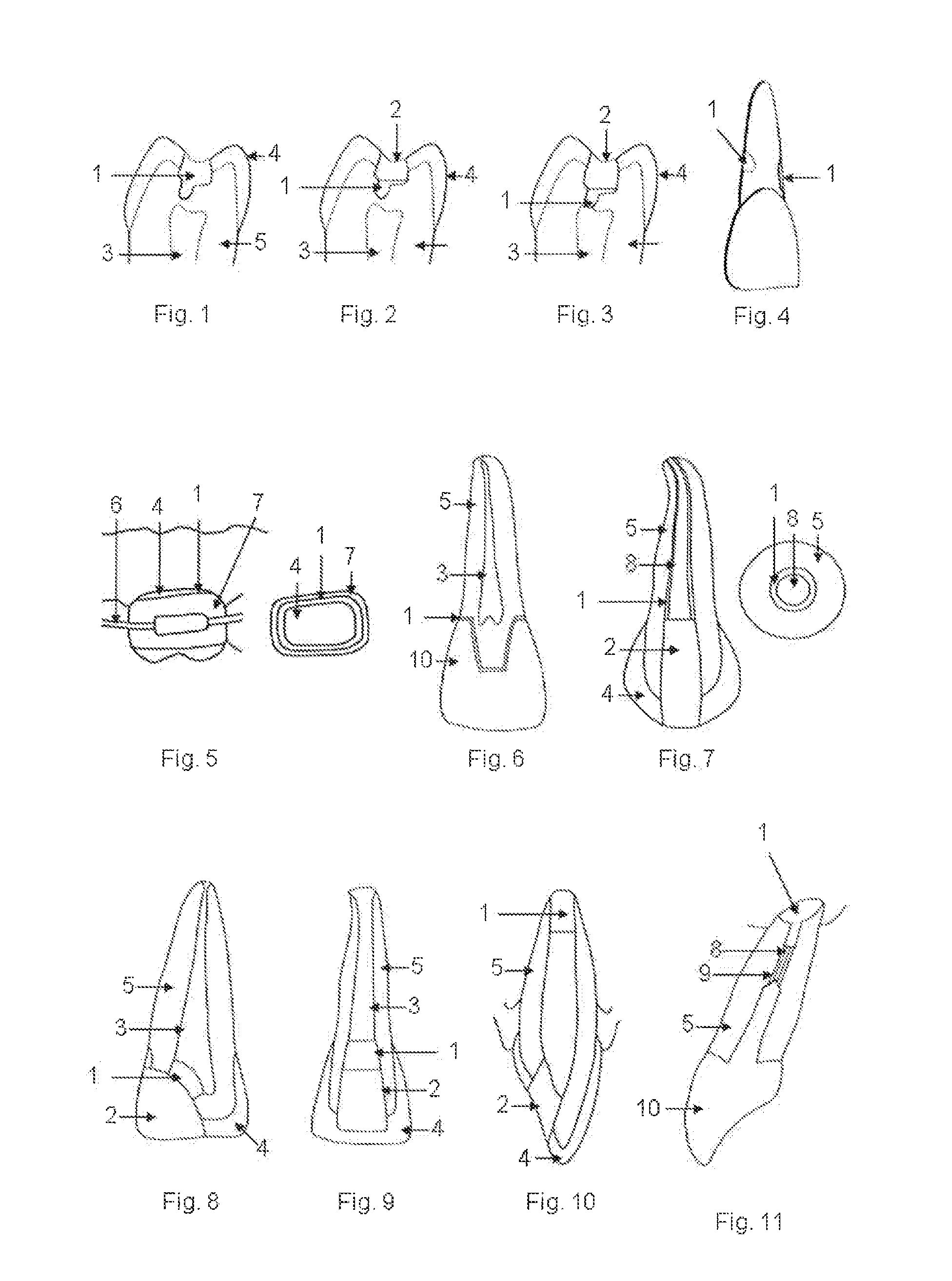 Mineral trioxide aggregate (MTA) composition and use