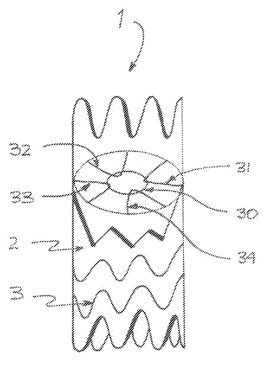 Vascular Filter Stent