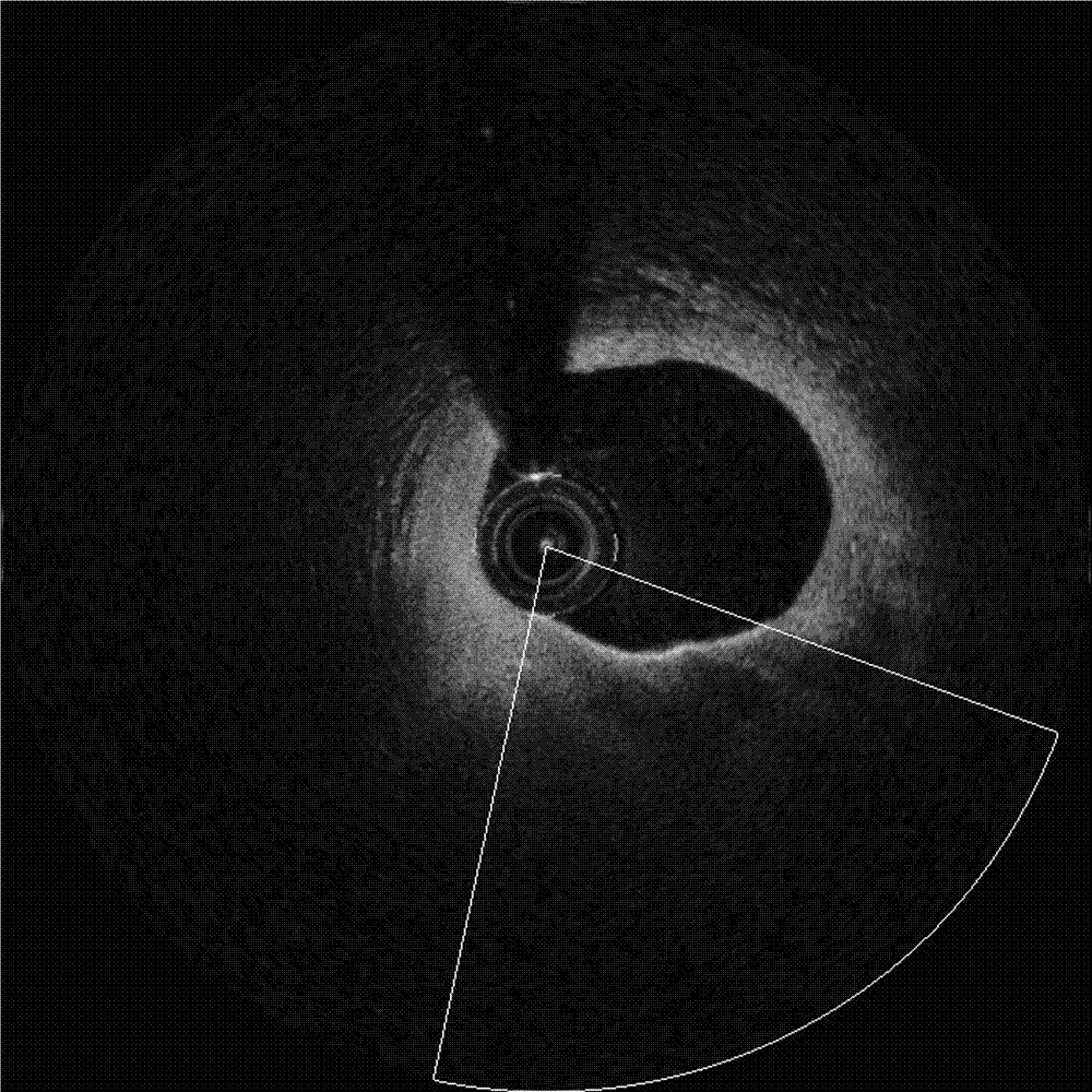 Automatic identification method of vulnerable plaques of cardiovascular optical-coherence-tomography (OCT) image