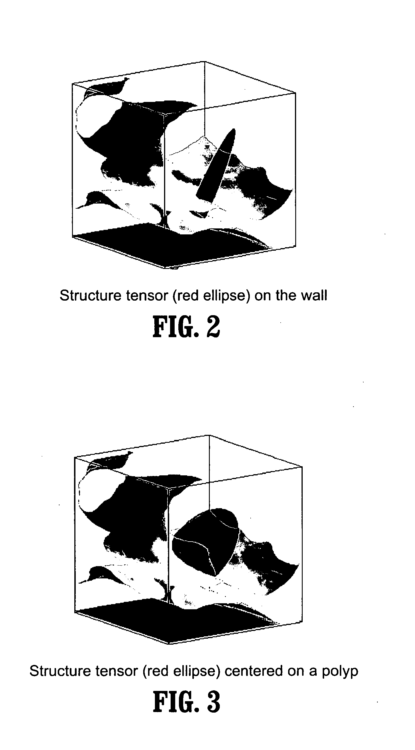 Method and system for using structure tensors to detect lung nodules and colon polyps