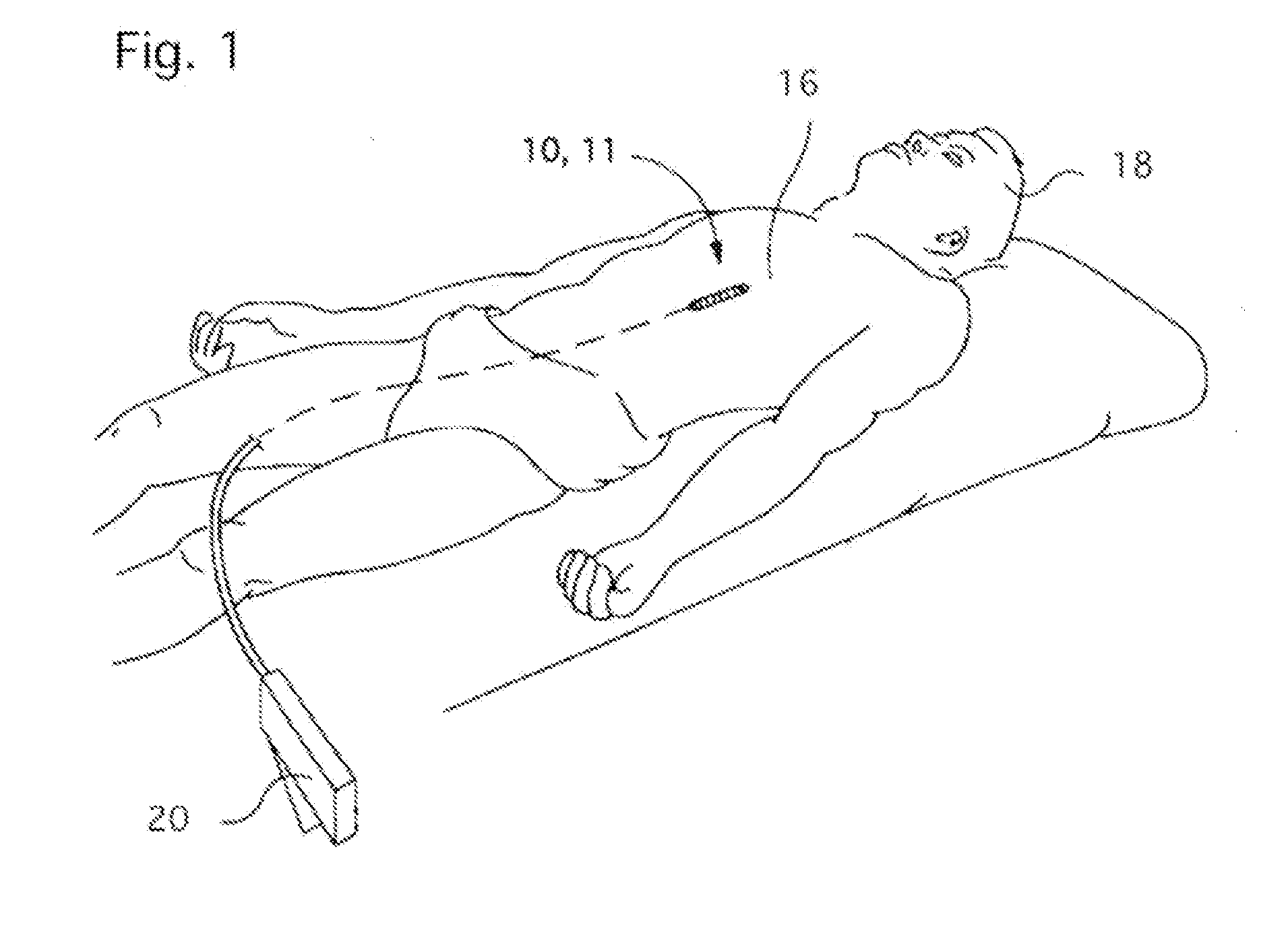 Angioplasty Balloon Catheter with Active Delivery Medicament(s) Using Ultrasonic Means