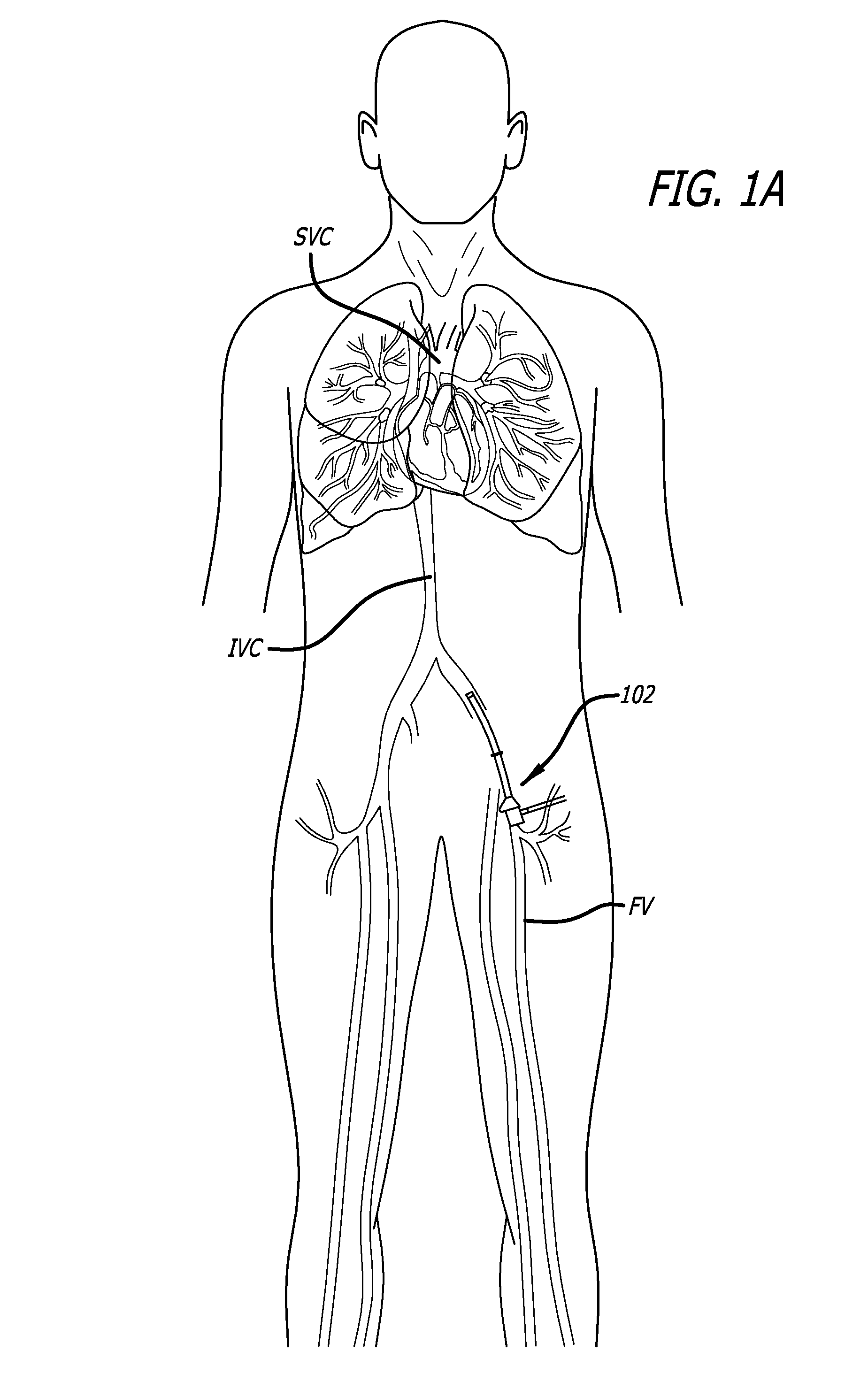 Methods And Apparatus For Treating Embolism