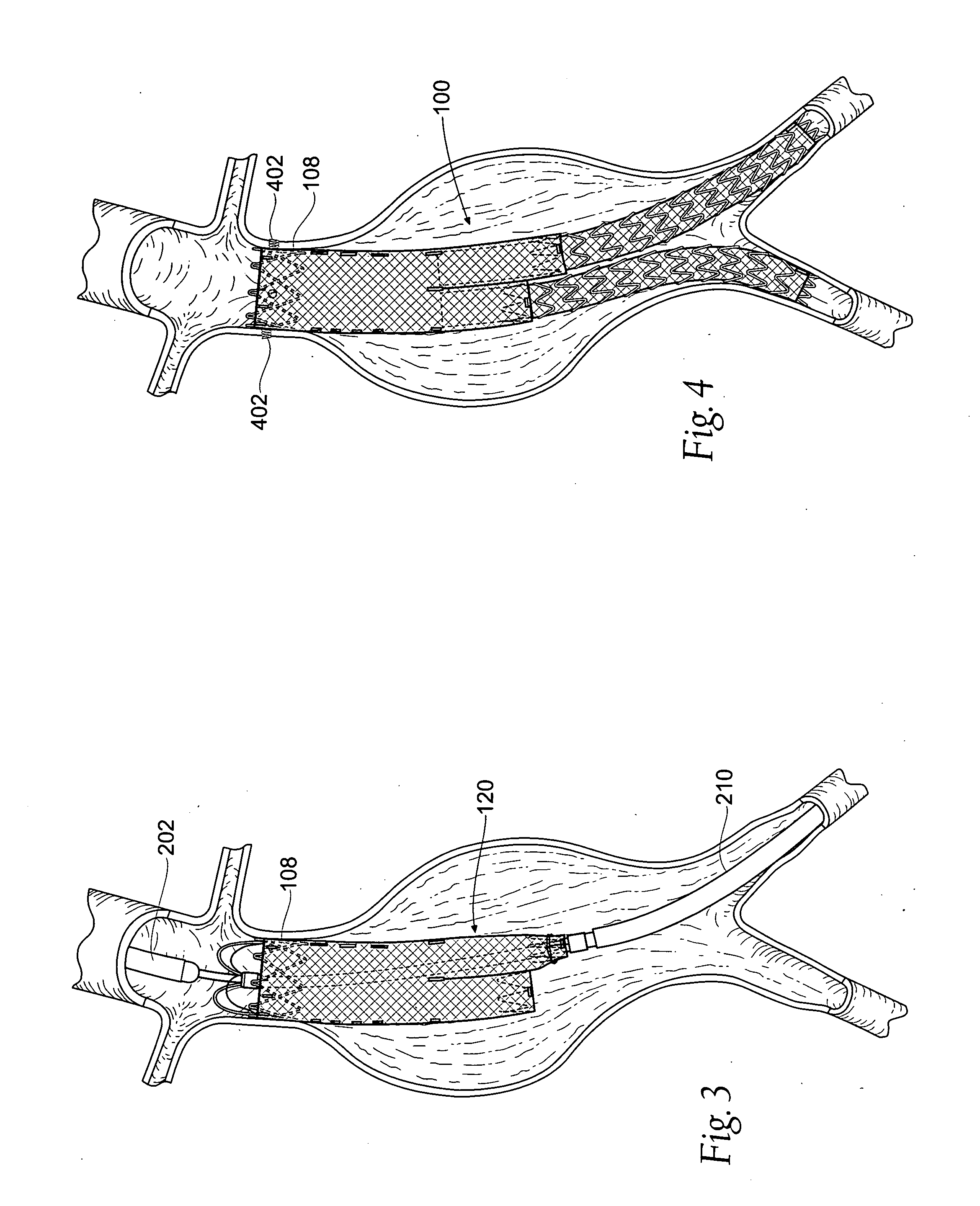 Devices, systems, and methods for prosthesis delivery and implantation