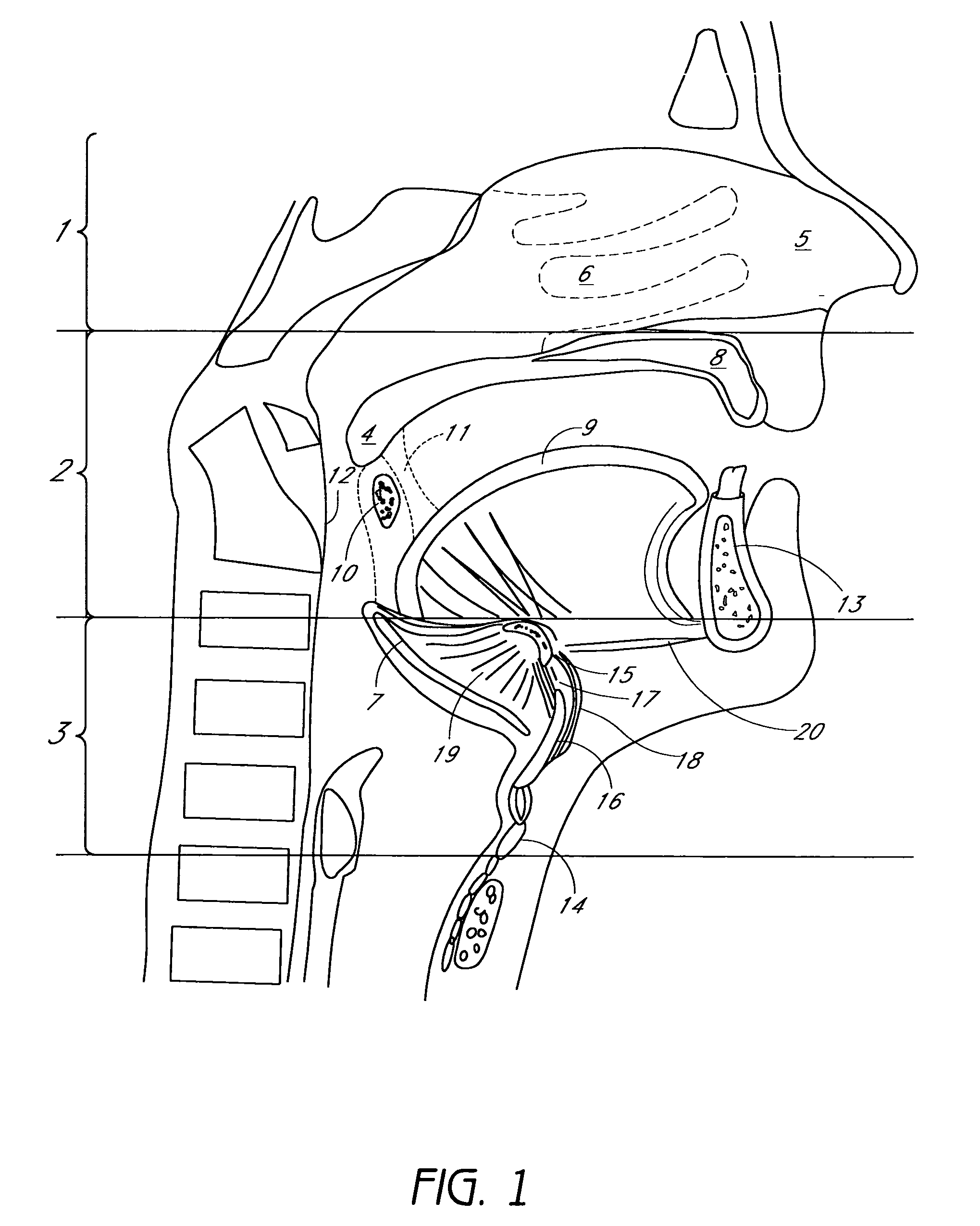 Tissue anchoring system for percutaneous glossoplasty