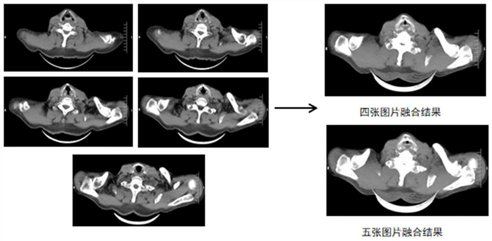 Acromioclavicular joint CT image processing method