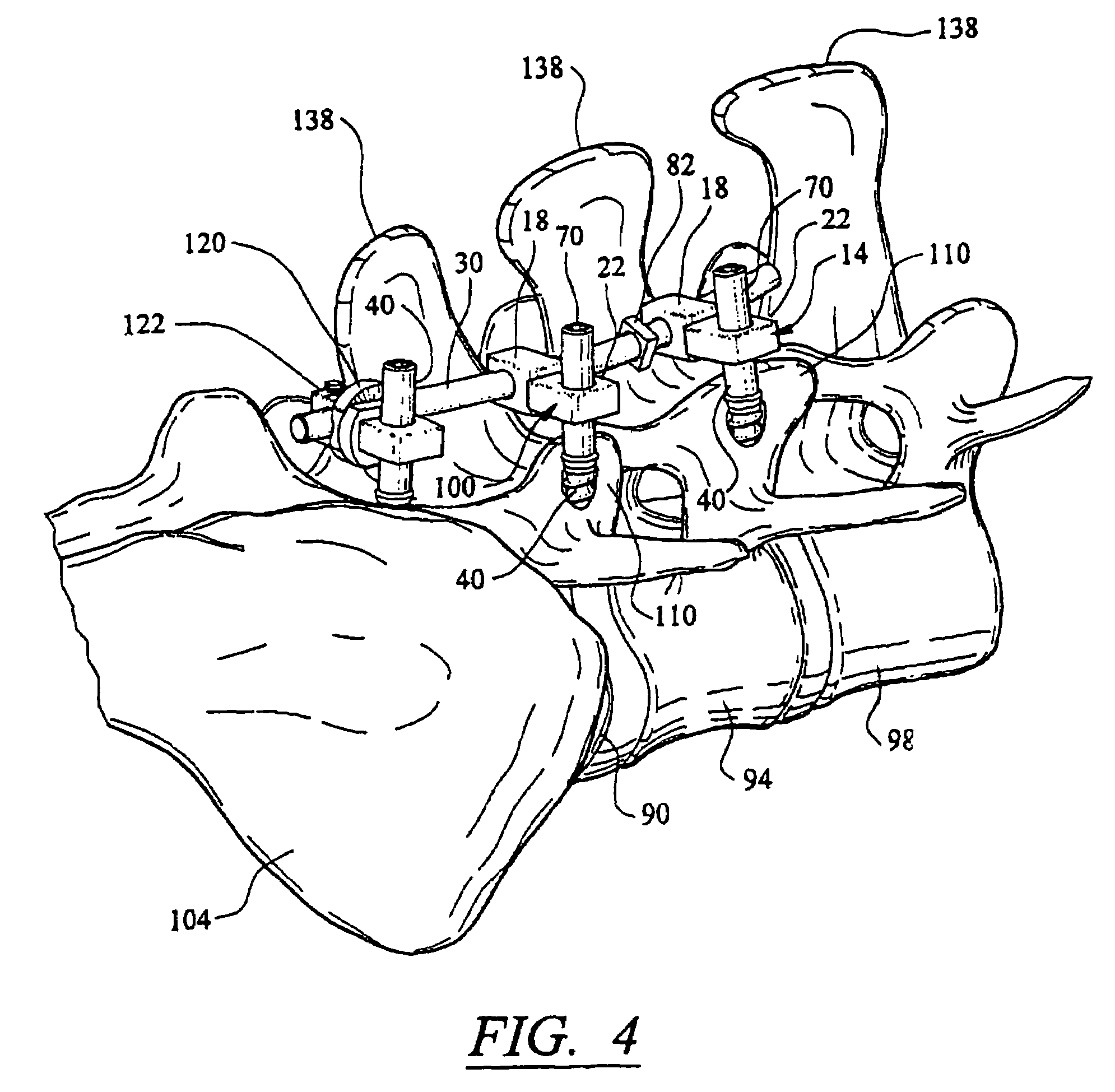 Method for creating an artificial facet