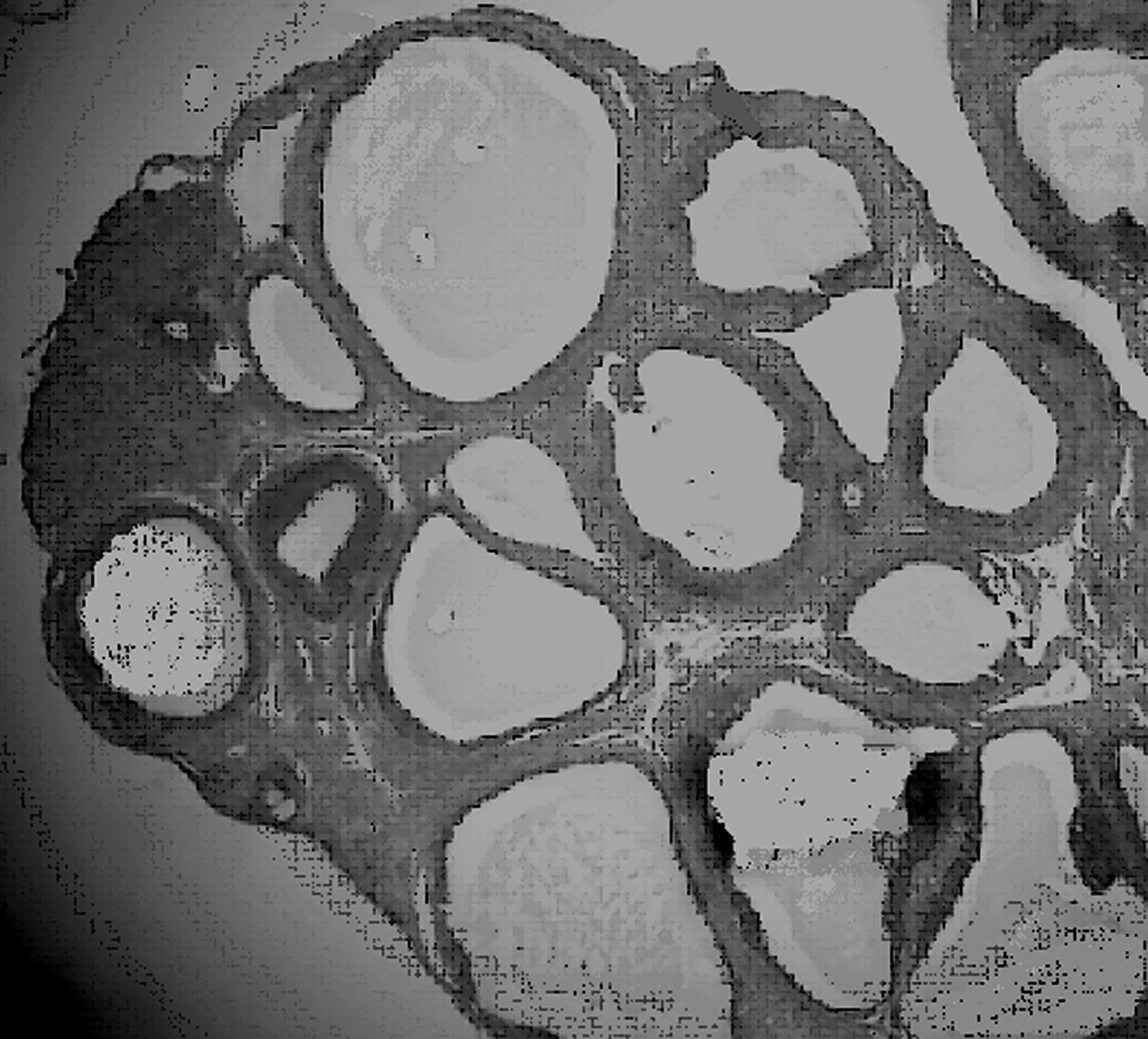 Chinese medicinal patch for treating polycystic ovary syndrome and preparation method thereof