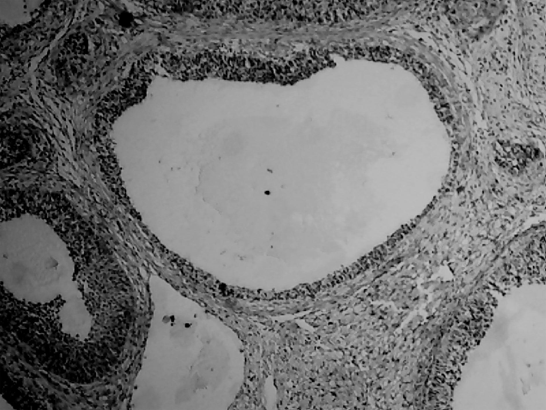 Chinese medicinal patch for treating polycystic ovary syndrome and preparation method thereof