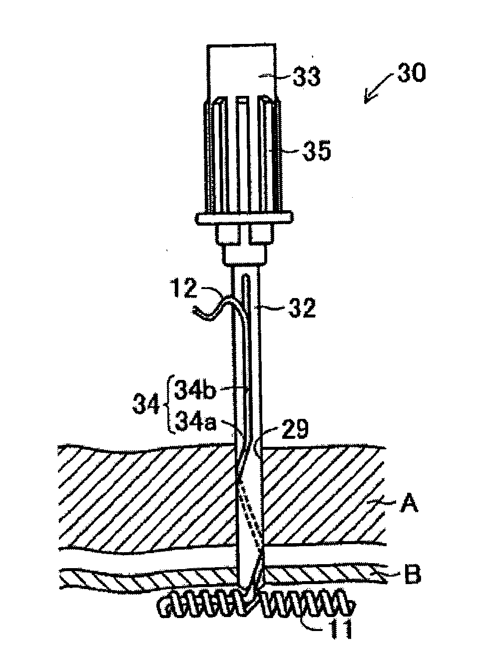 Surgical Fastener, Surgical Fastener Kit and Removing Tool