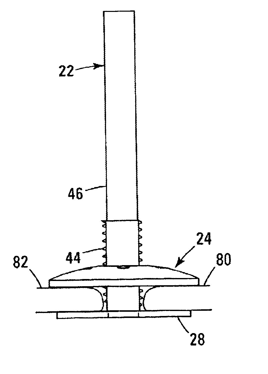 Cranial flap fixation device