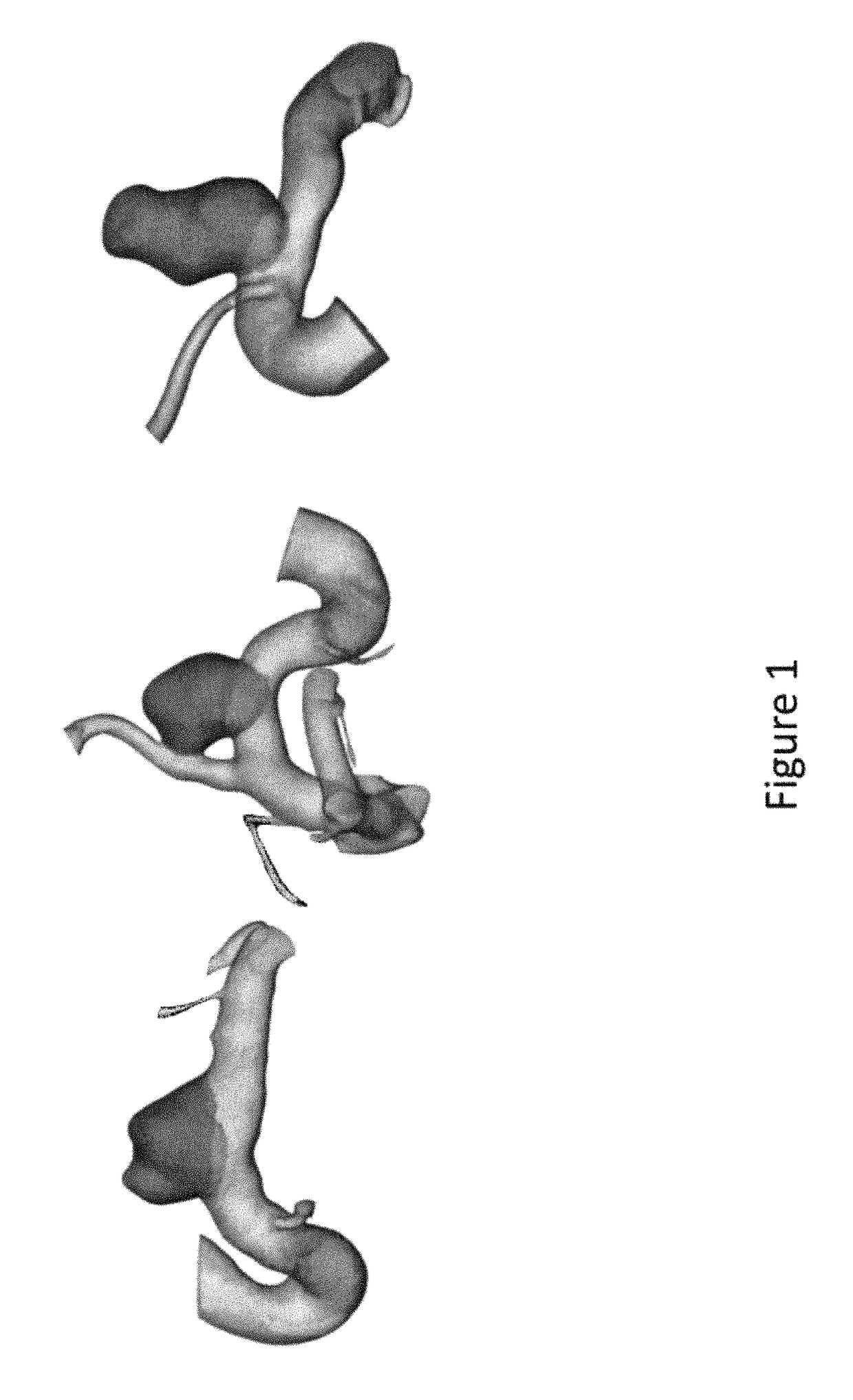 Method for intracranial aneurysm analysis and endovascular intervention planning