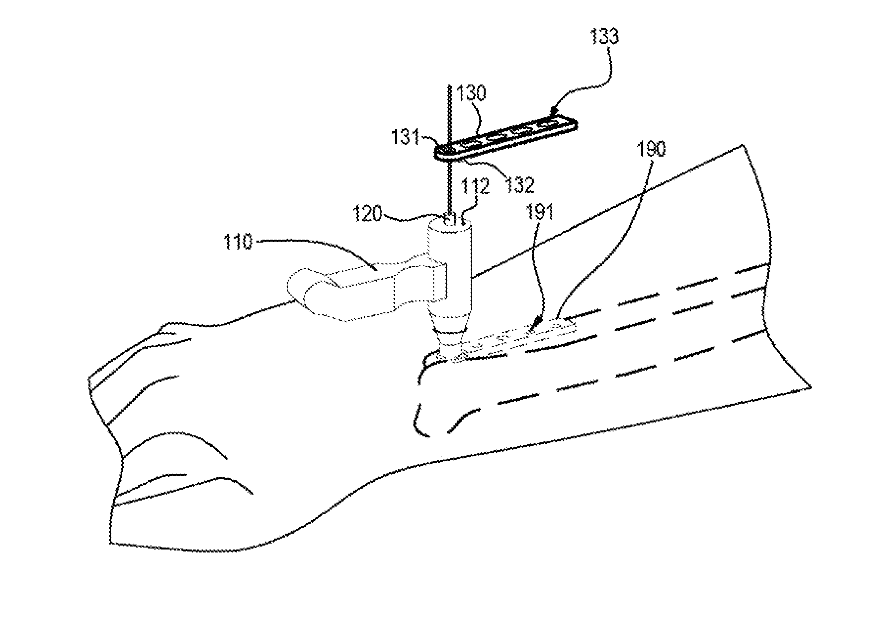 Bone fixation guide device