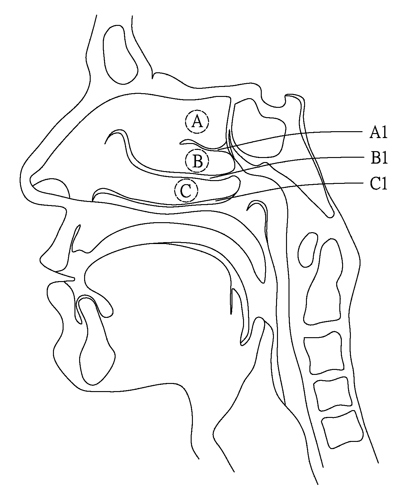 Nasal passage irrigation catheter device