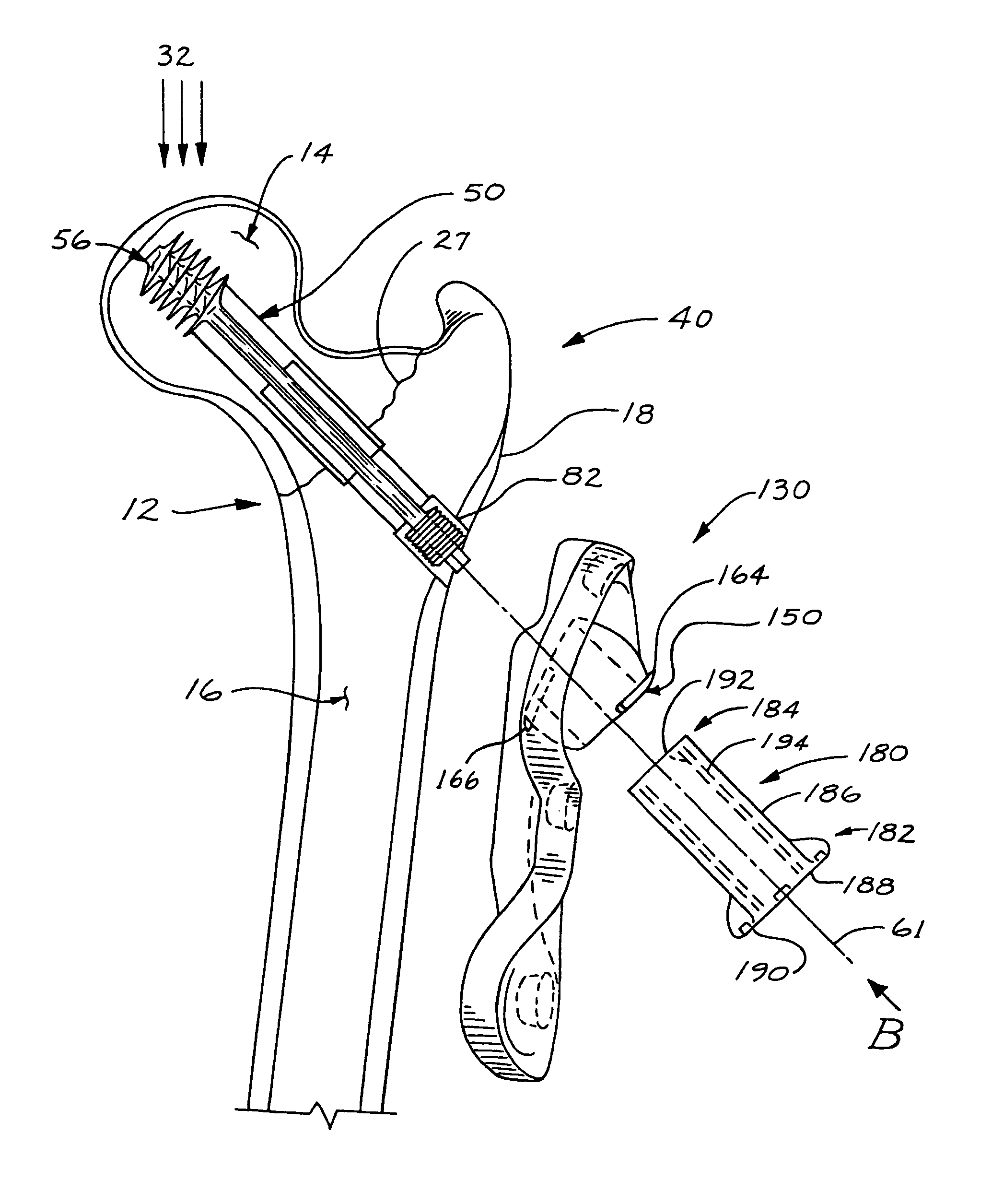 Compression bone screw device