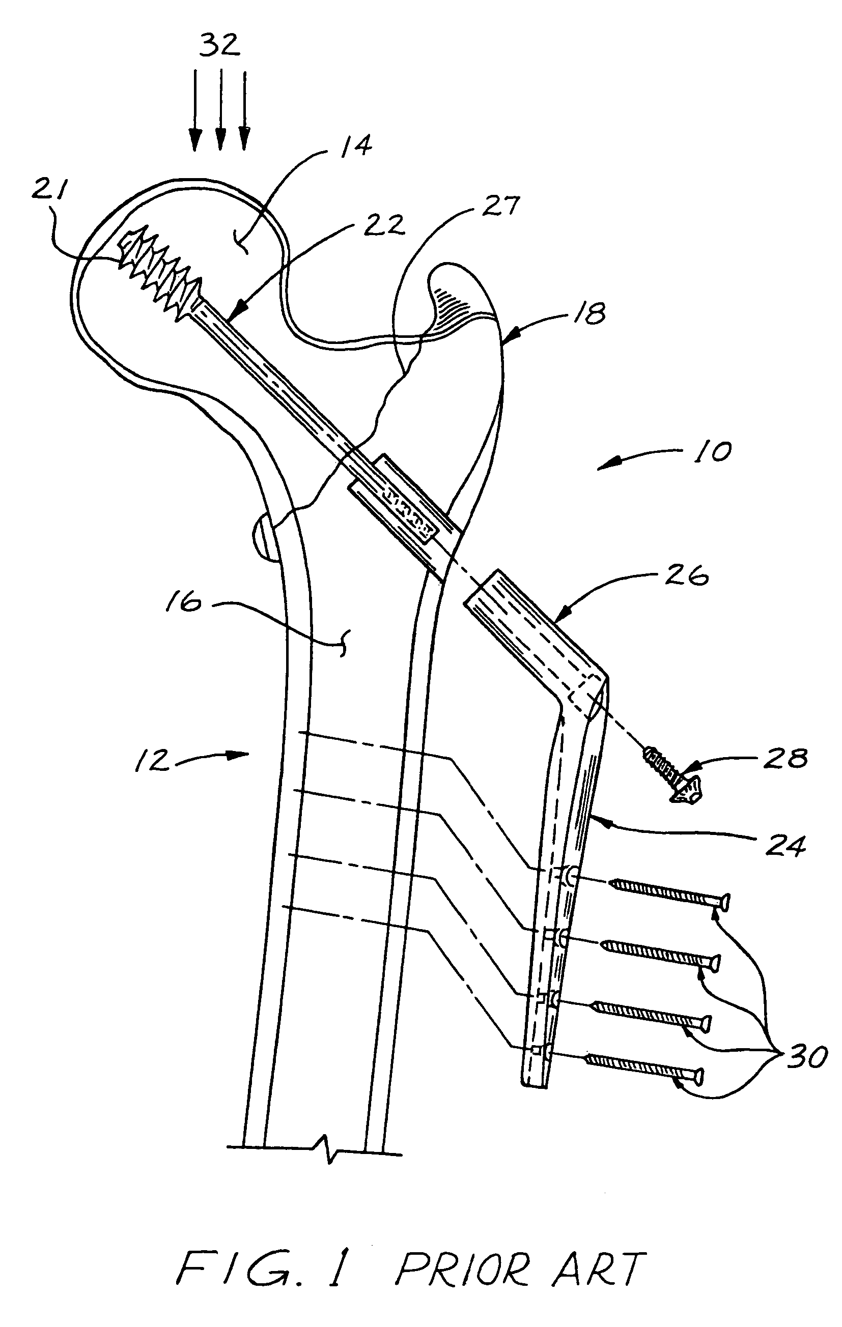 Compression bone screw device