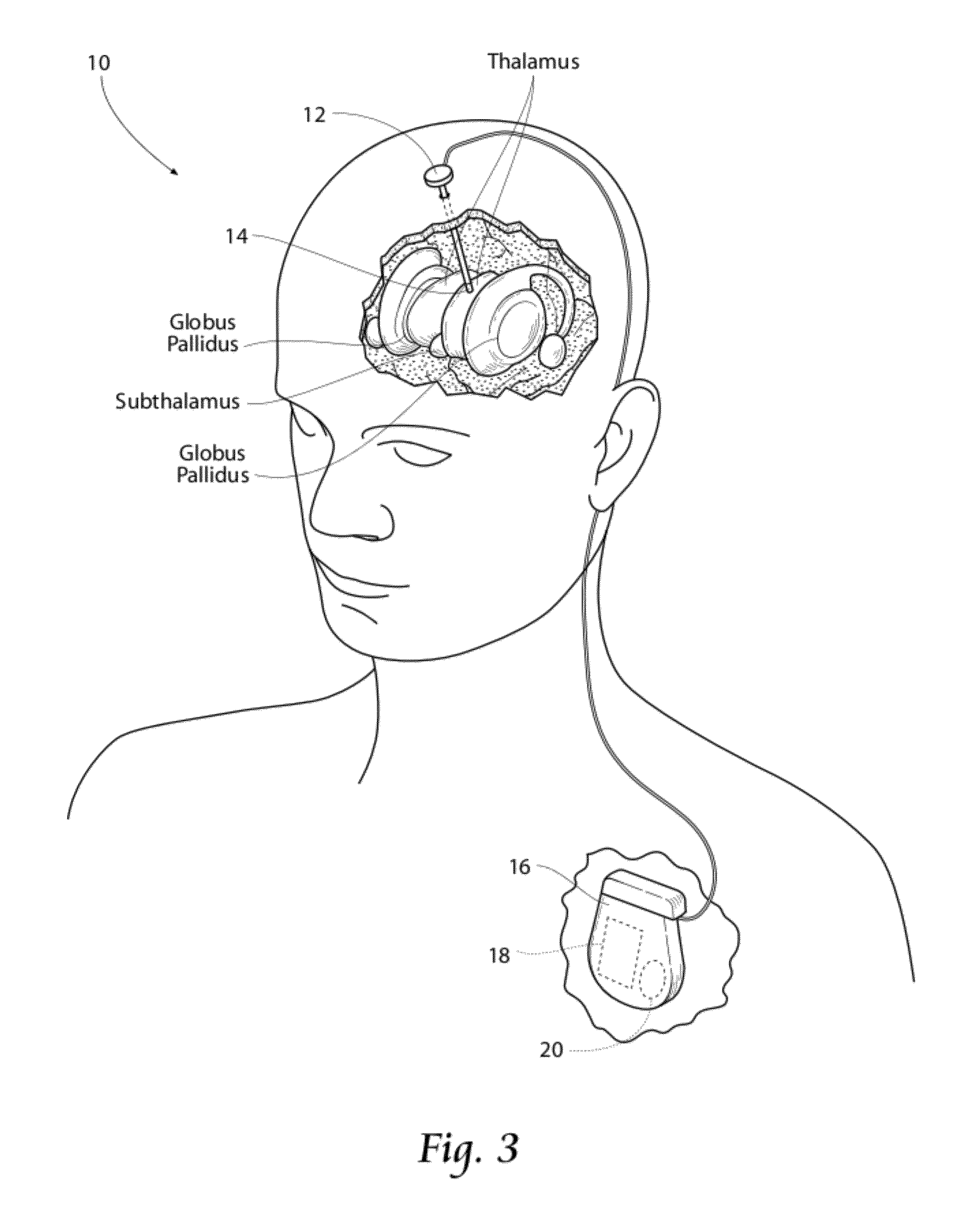 Waveform shapes for treating neurological disorders optimized for energy efficiency