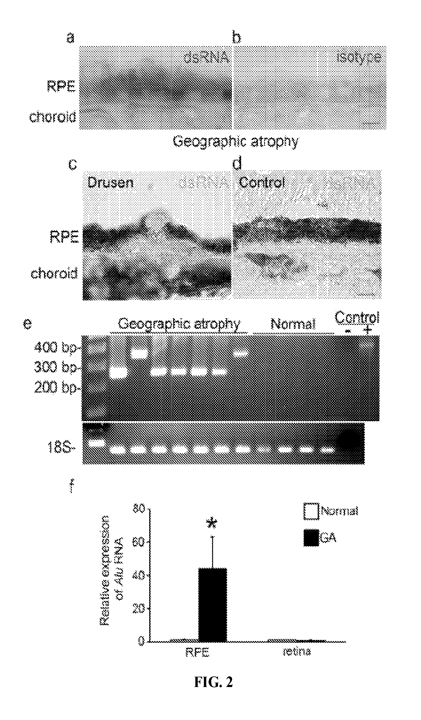 Method of inhibiting Alu RNA and therapeutic uses thereof