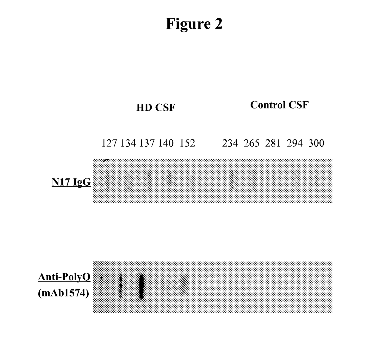 Diagnostic and monitoring system for Huntington's disease