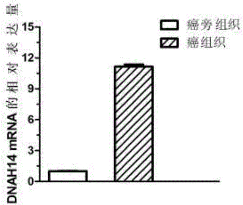 Application of DNAH14 gene in tumor diagnosis and treatment