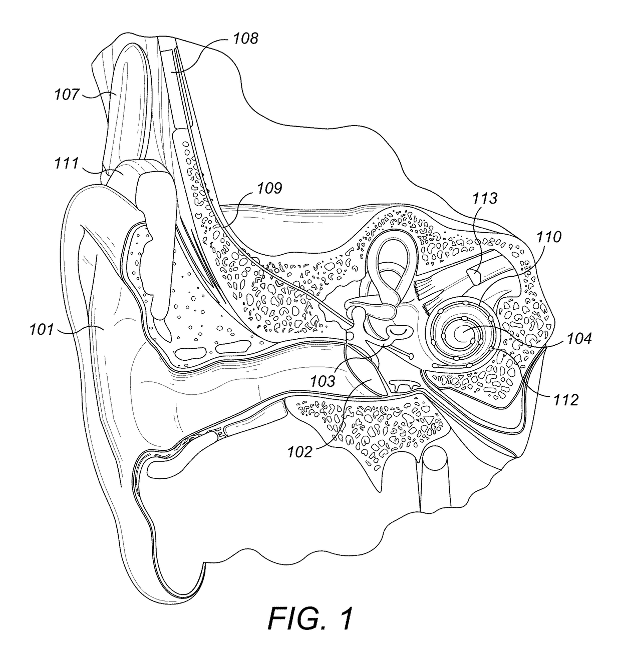 Electrode lead that avoids electrode array migration from the cochlea