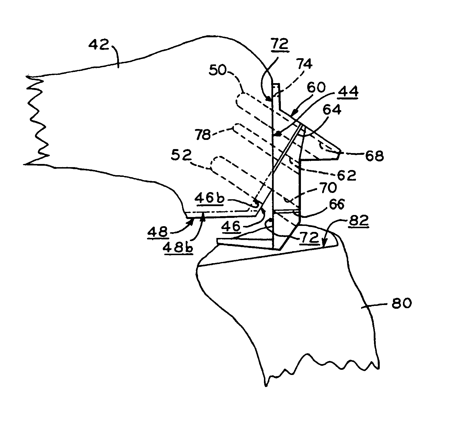 Provisional orthopedic implant and recutting instrument guide