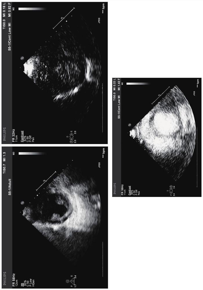 Gene-carrying developing microvesicle used for gene targeted therapy of ischemic heart disease, and preparation method of gene-carrying developing microvesicle