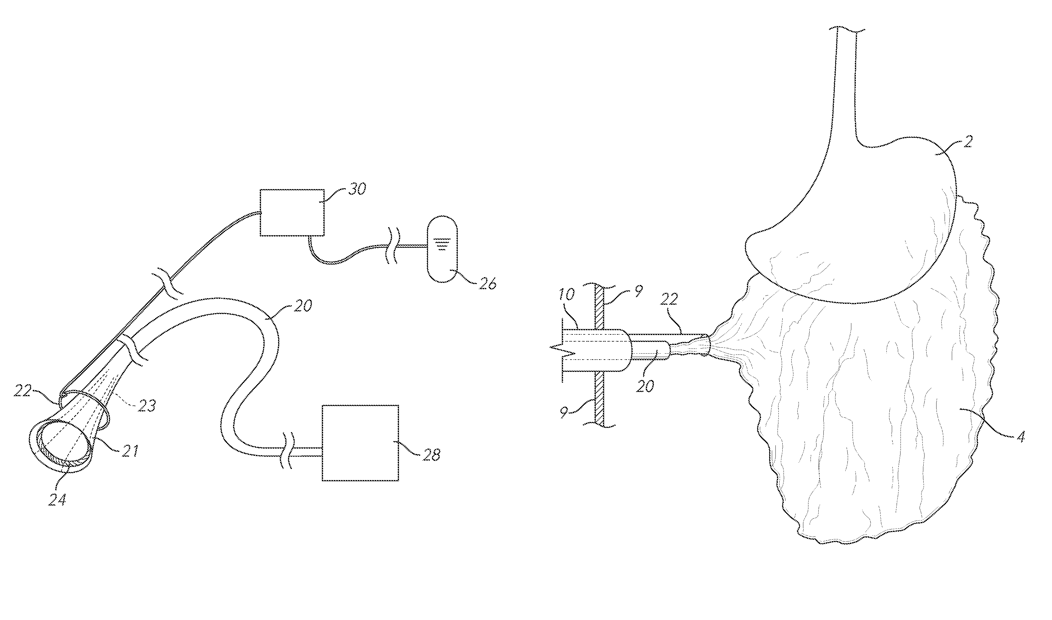 Methods and devices for removing omental tissue