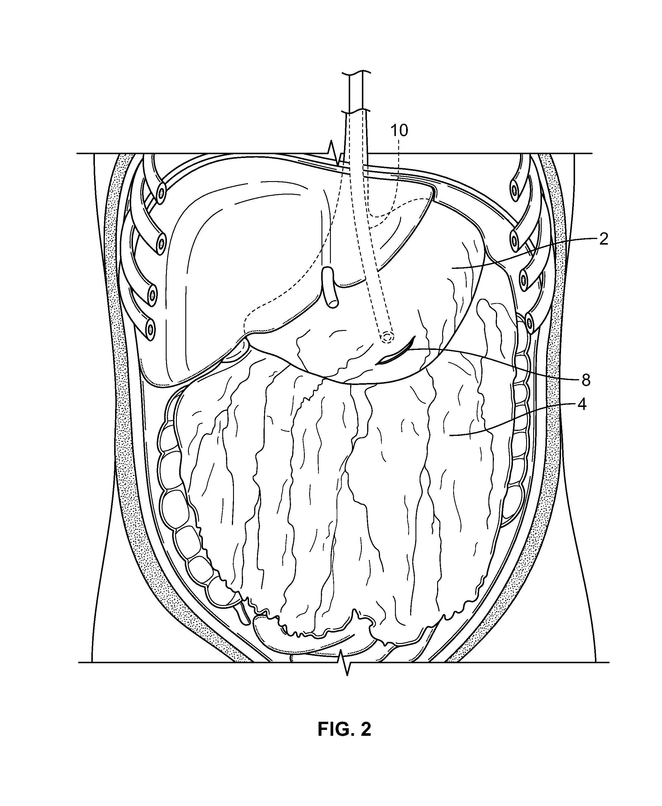 Methods and devices for removing omental tissue