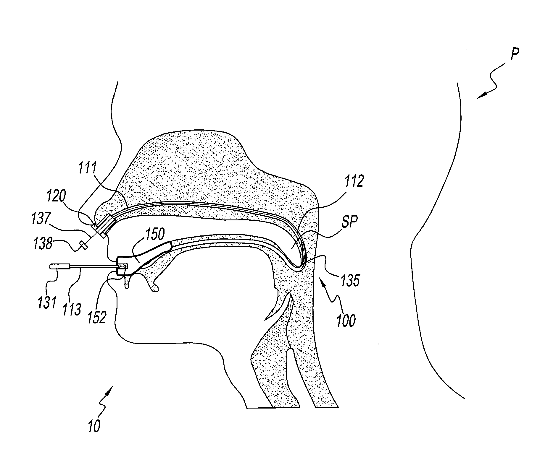 Apparatus and methods for the treatment of sleep apnea