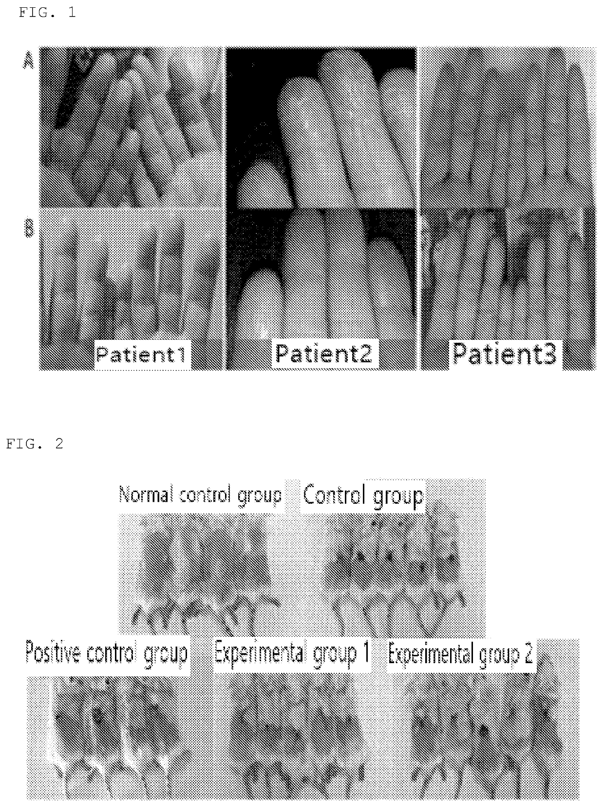 Pharmaceutical composition comprising purple corn extract for prevention or treatment of skin disease