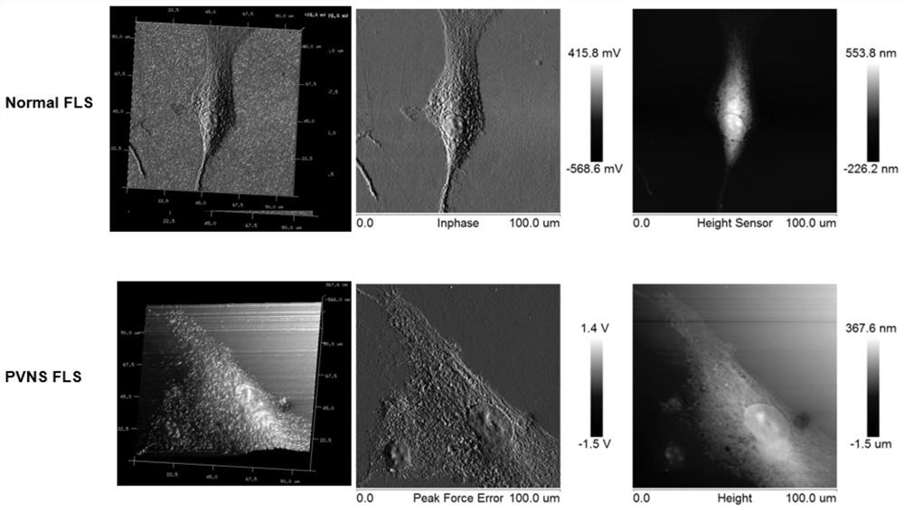 Application of GLUT1 as prevention and/or treatment target of hyperpigmented villus nodular synovitis