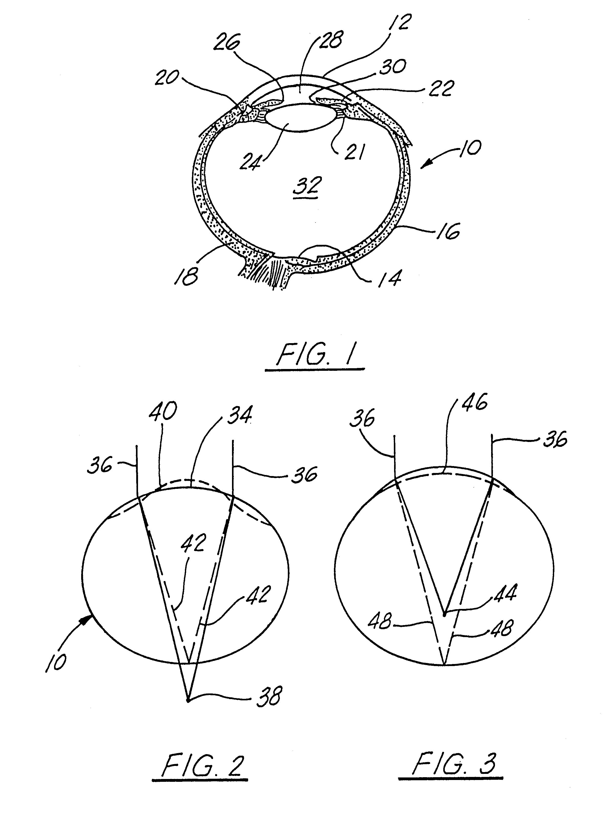 Corneal implant and method of manufacture