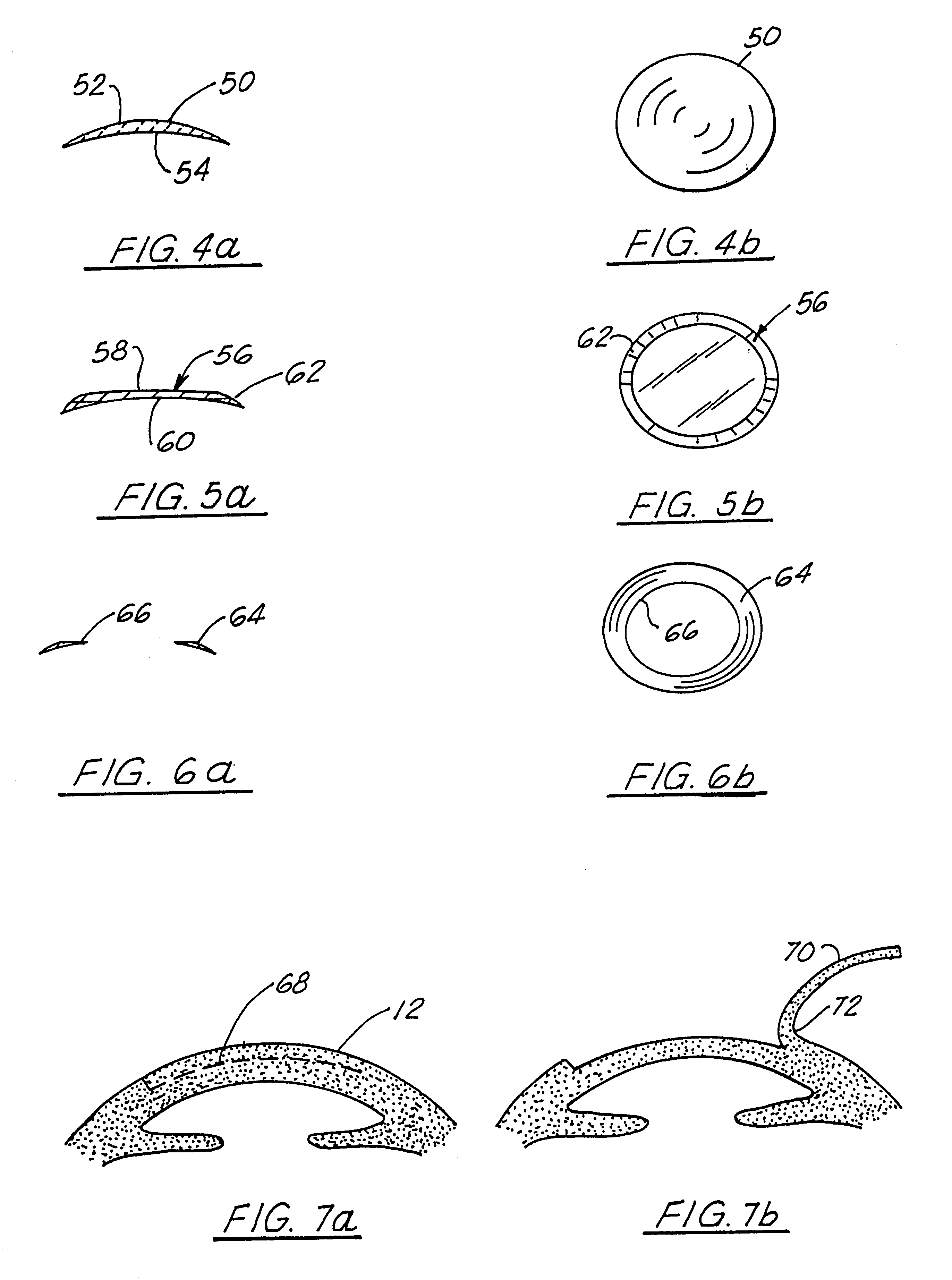 Corneal implant and method of manufacture