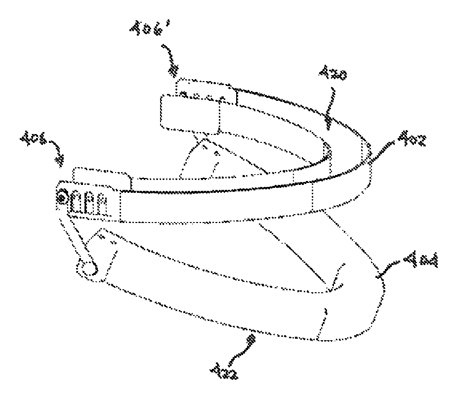 Mandibular advancement appliance