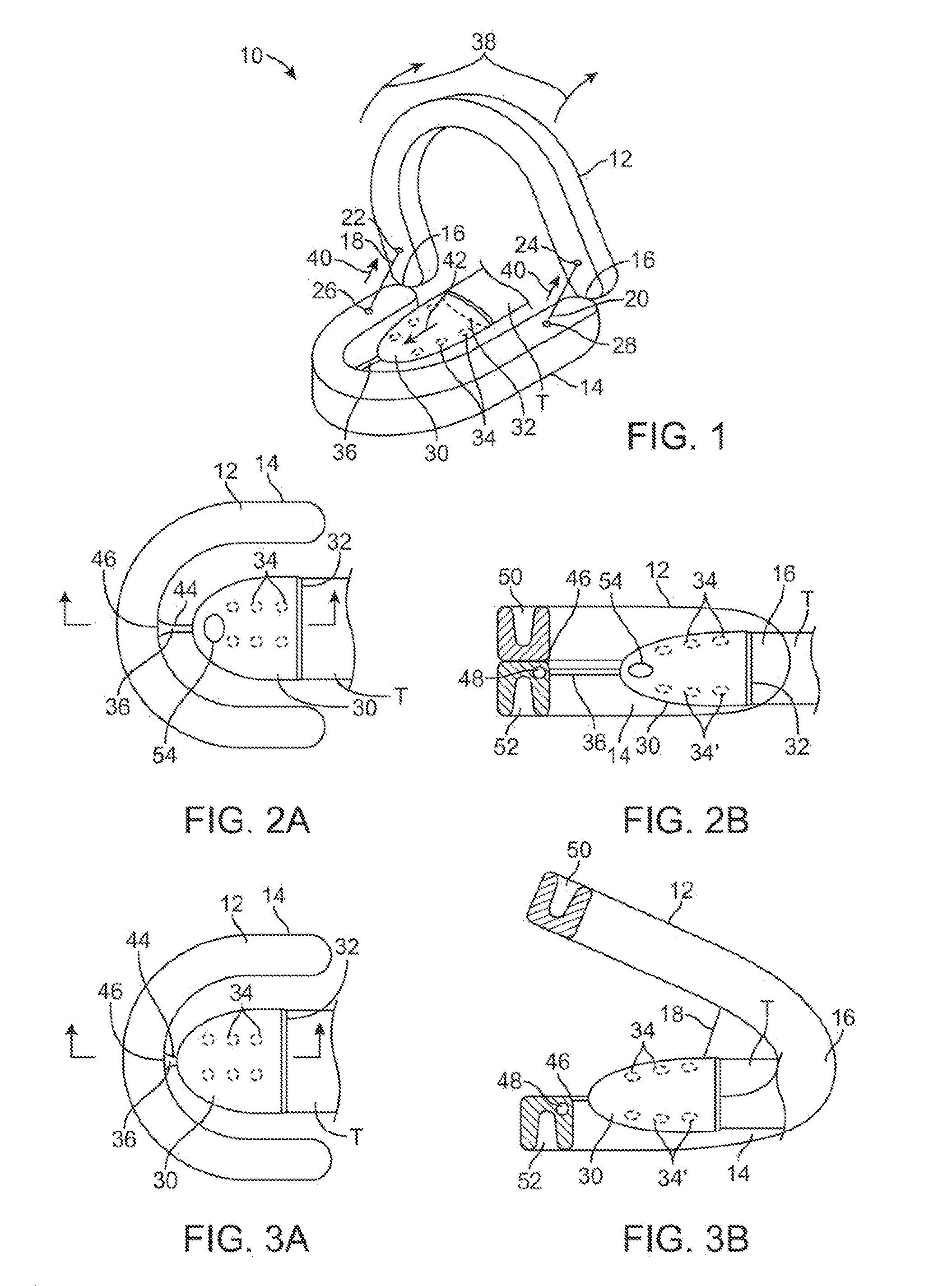 Mandibular advancement appliance