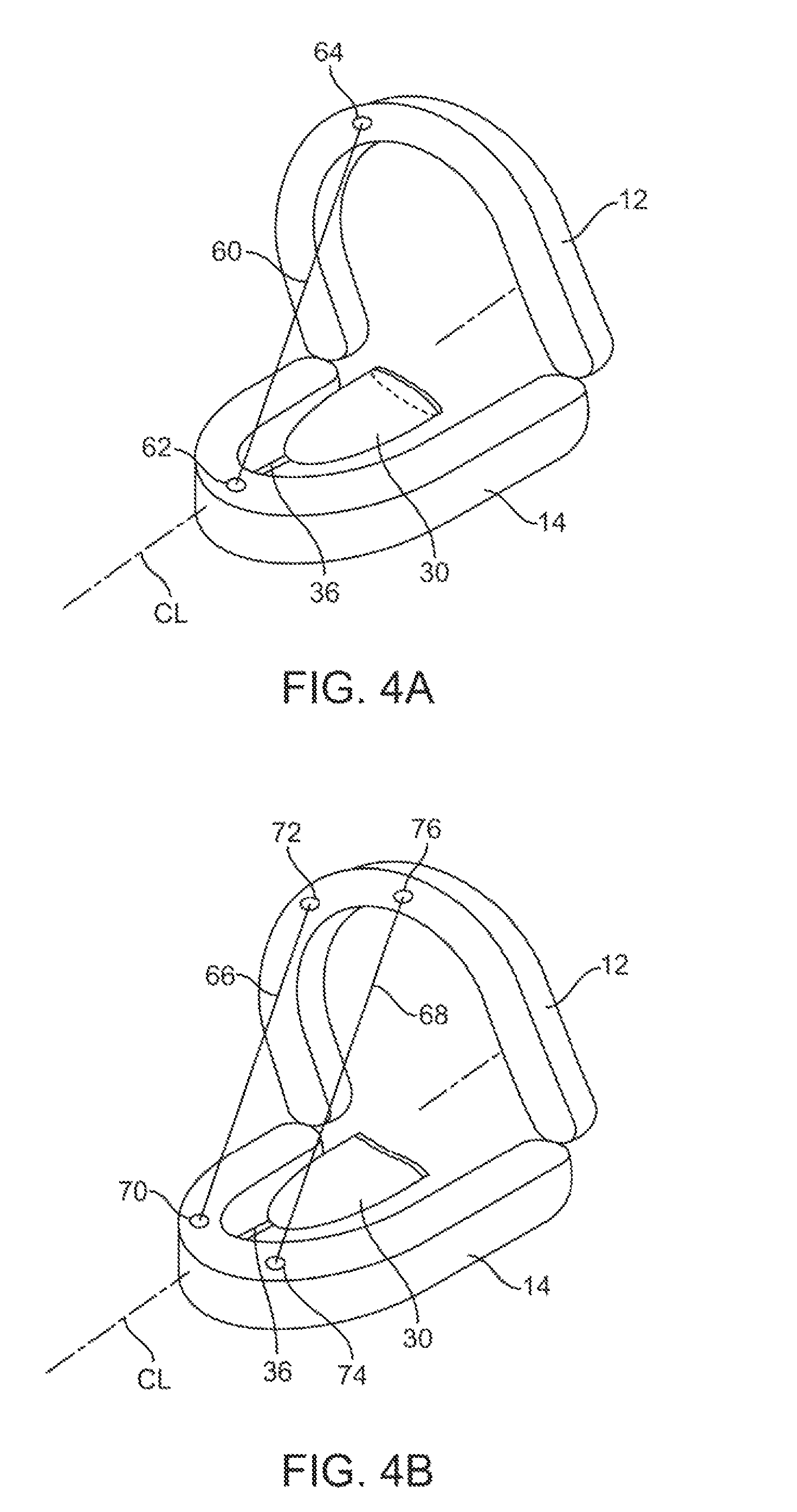 Mandibular advancement appliance