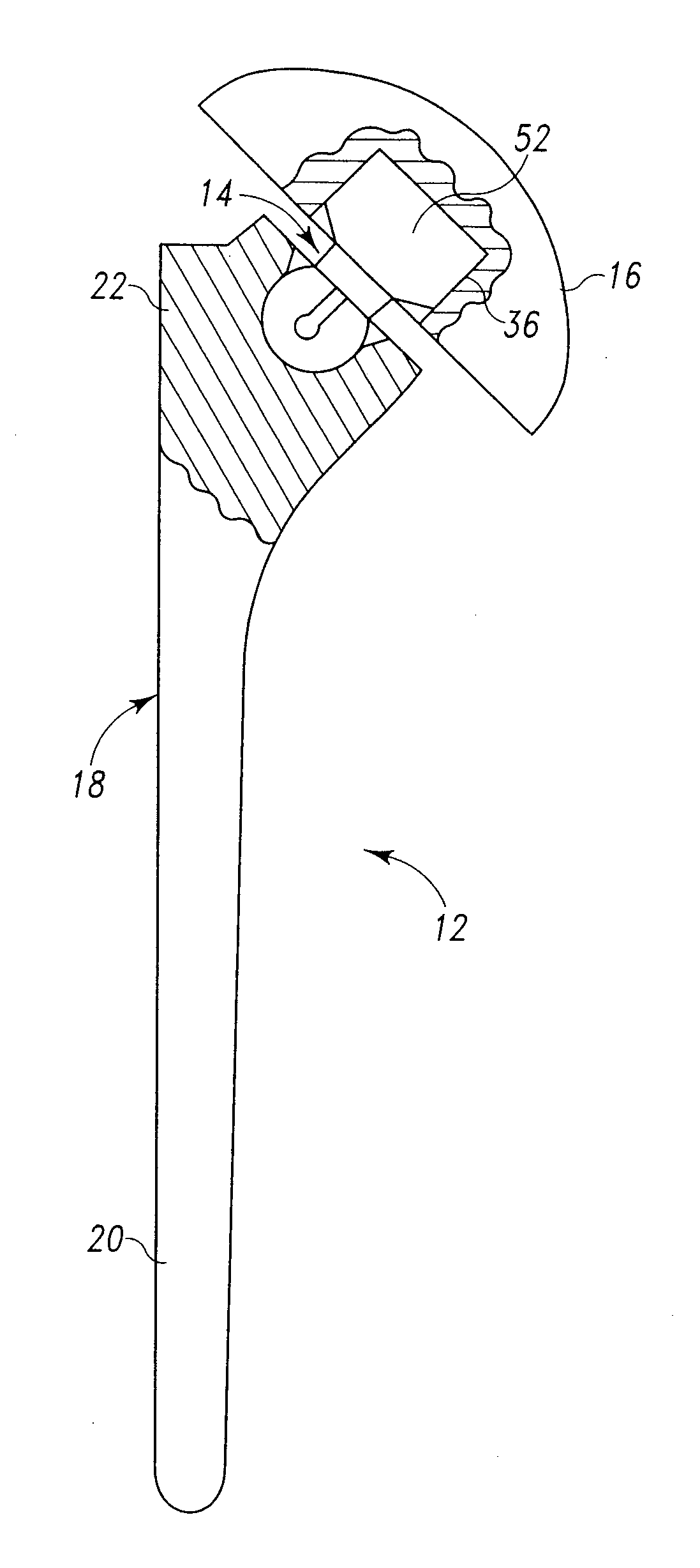 Shoulder prosthesis adjustable humeral head mechanism