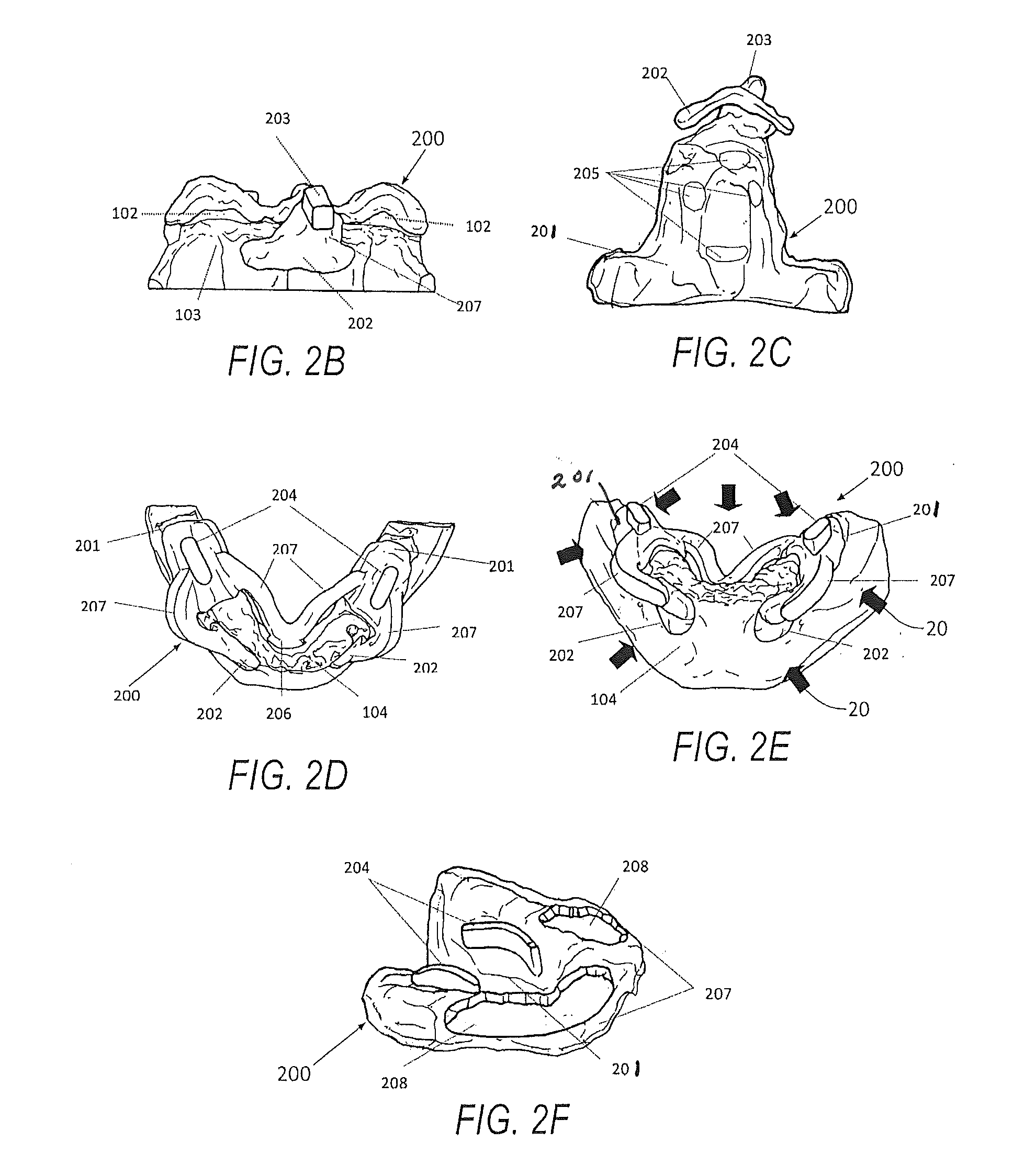 Edentulous surgical guide