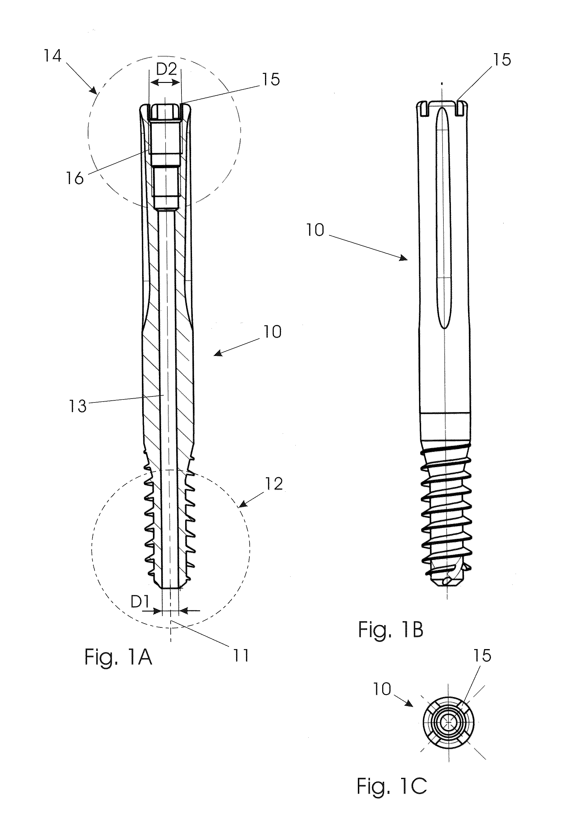 Modular lag screw