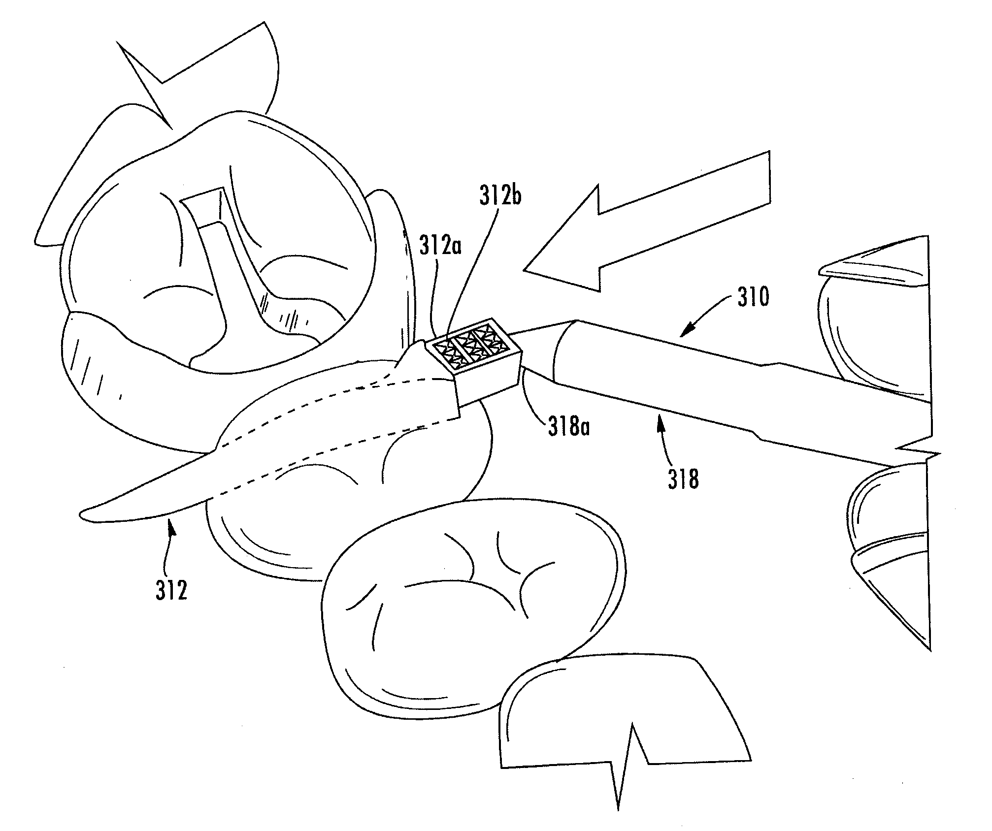 Wedge for use in dental restoration