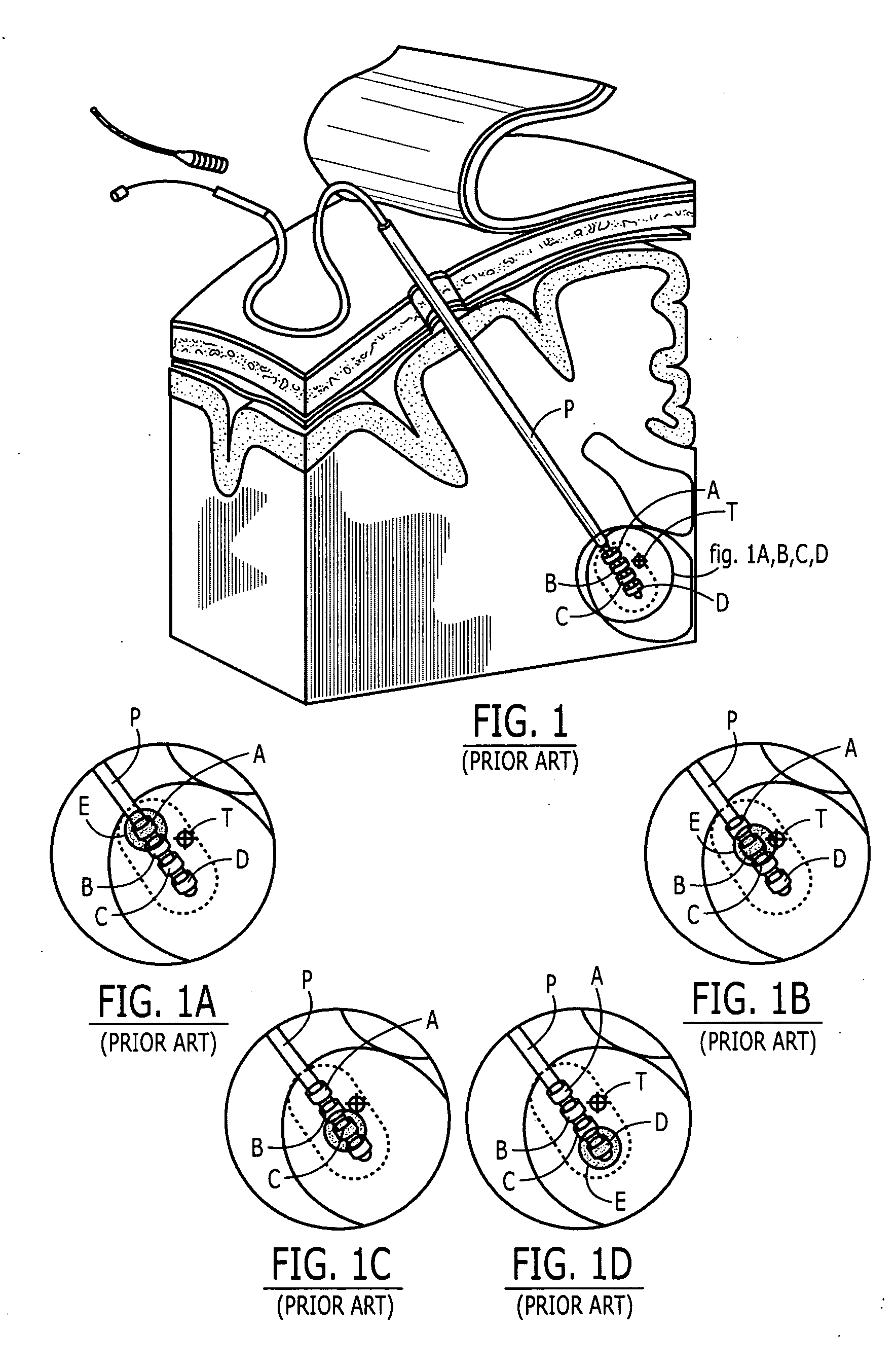 Various apparatus and methods for deep brain stimulating electrodes