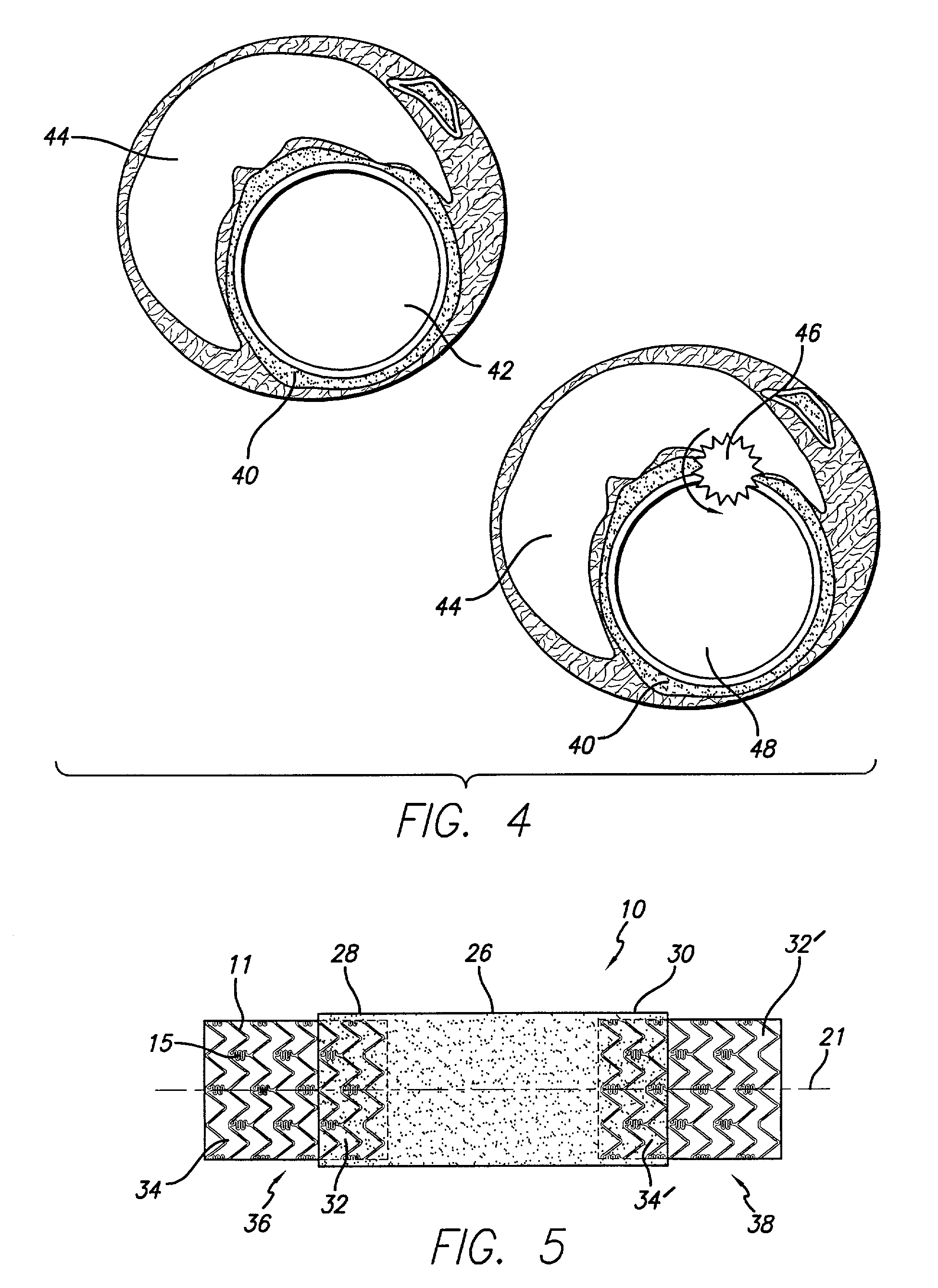 Stent assembly for the treatment of vulnerable plaque