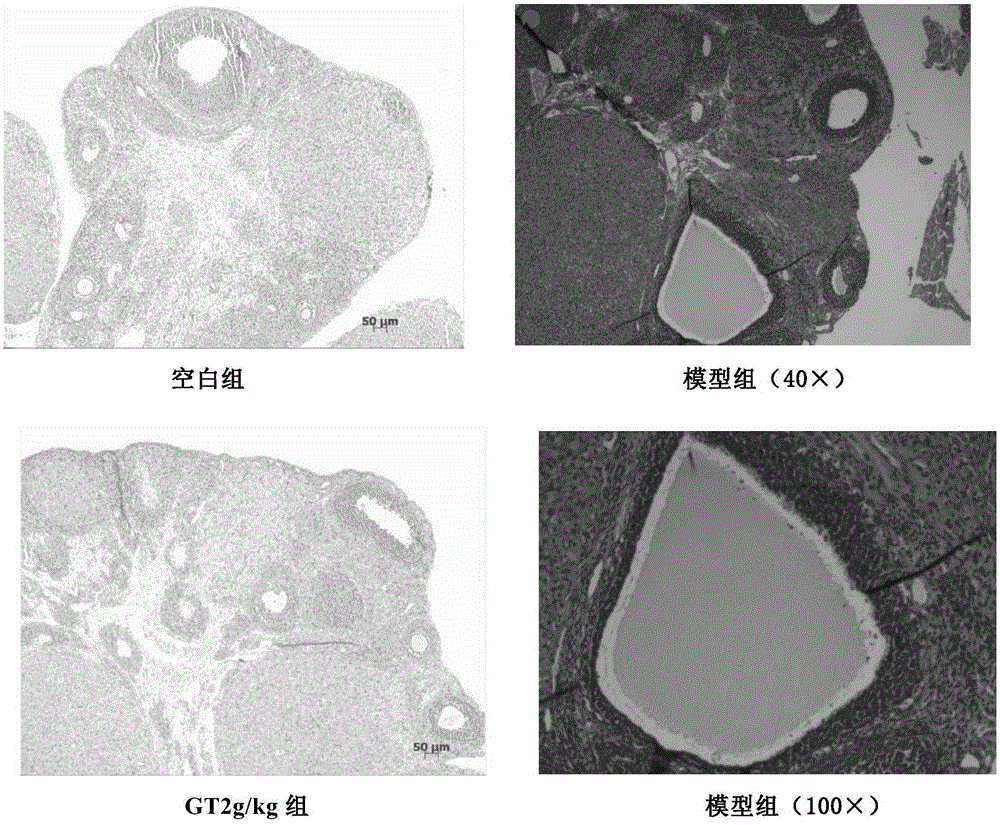 Application of triglyceride compound in preparation of medicine for treating polycystic ovarian syndrome