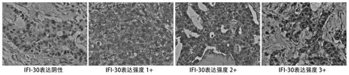 Application of protein/gene IFI30 related to breast cancer occurrence and development