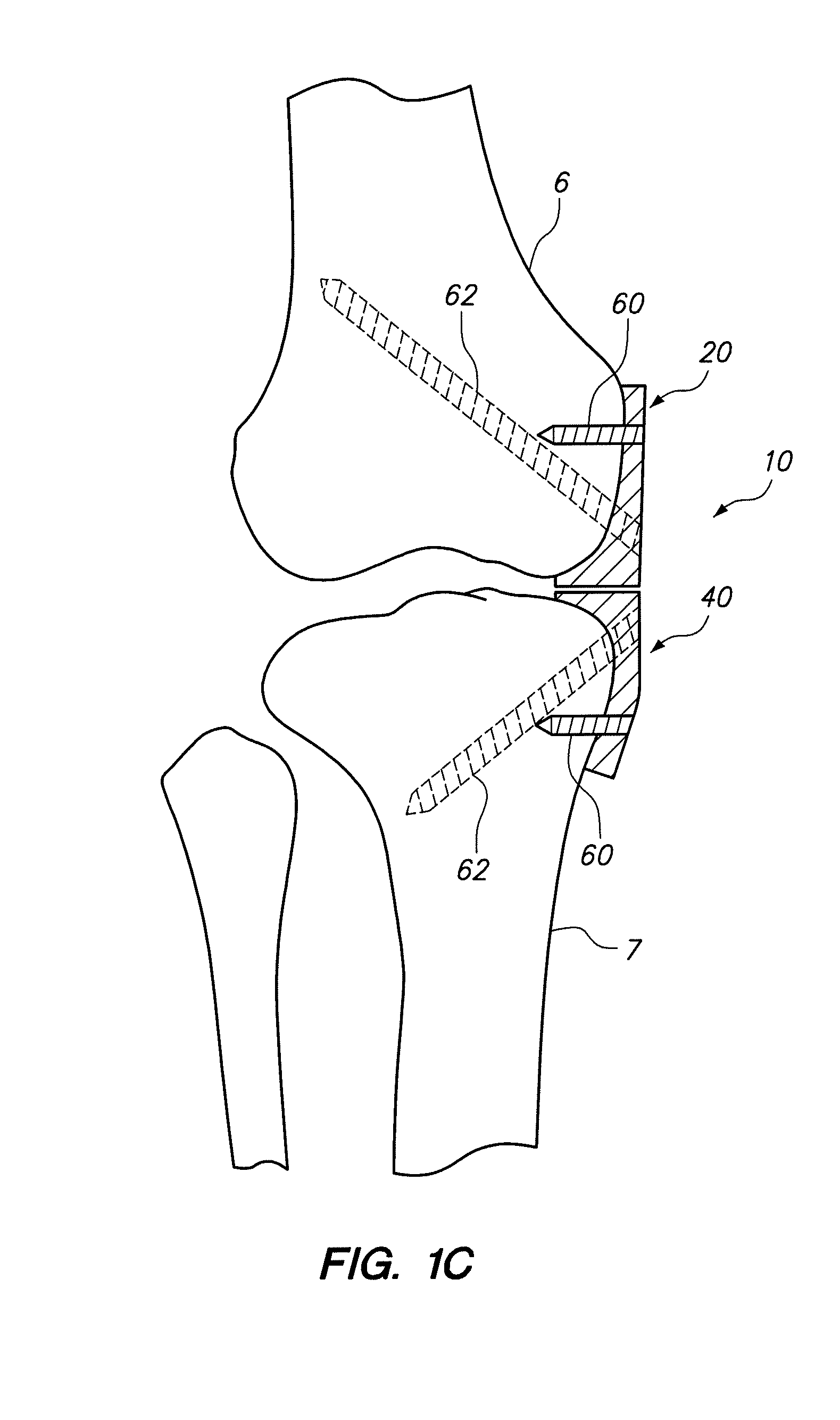 Implantable brace for providing joint support