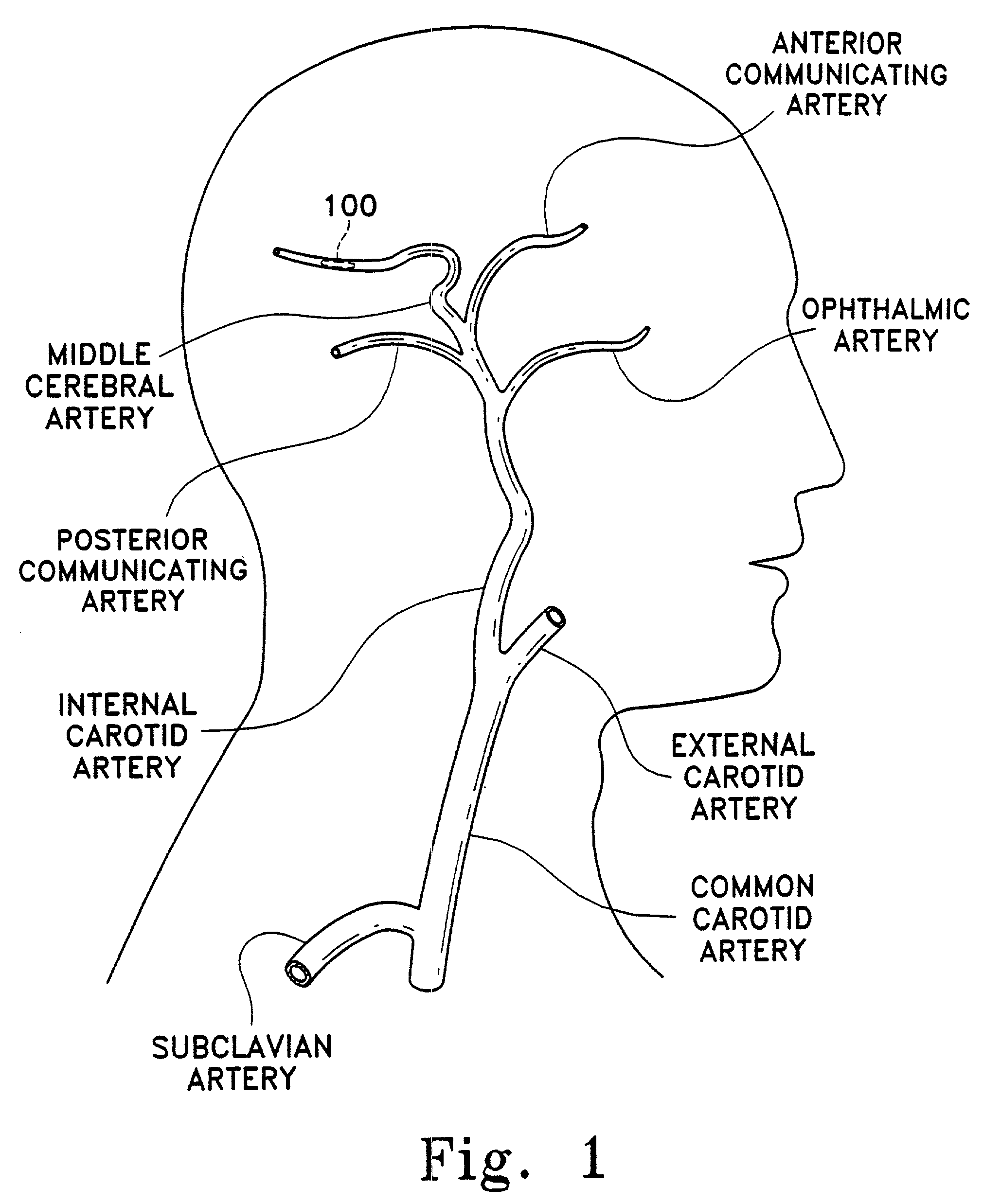 Mechanical clot treatment device