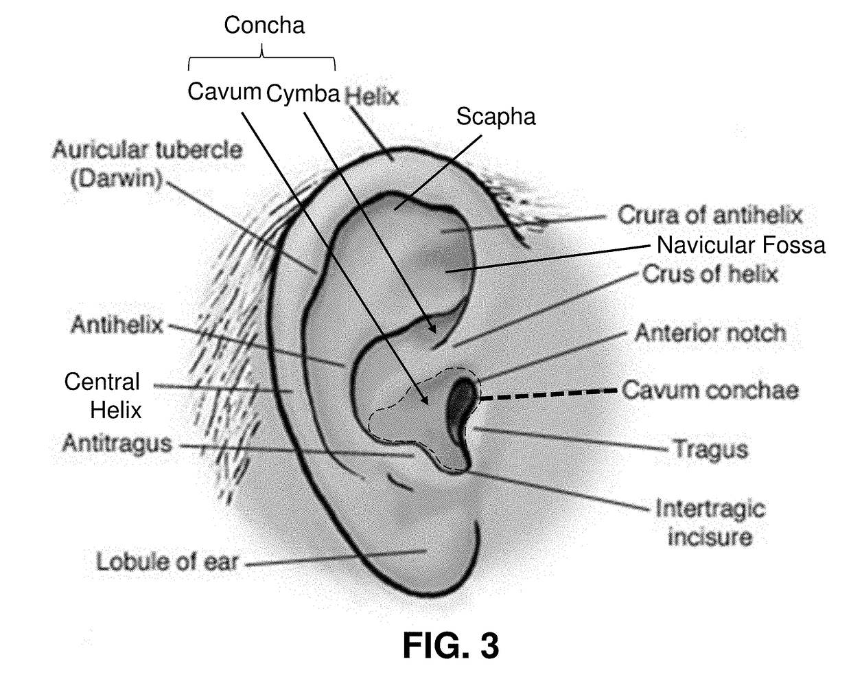 Transcutaneous electrostimulator and methods for electric stimulation