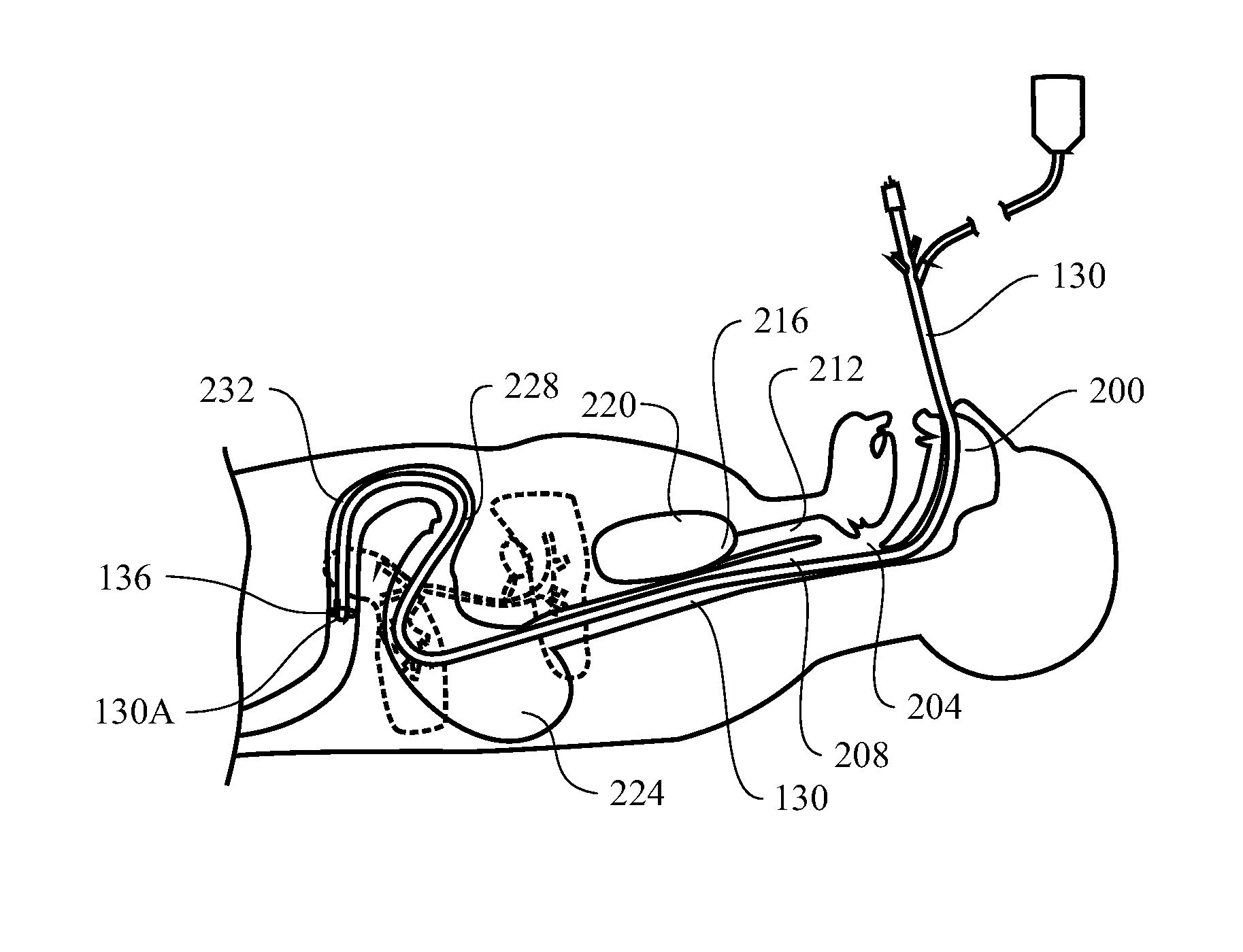 Optically guided medical tube and control unit assembly and methods of use